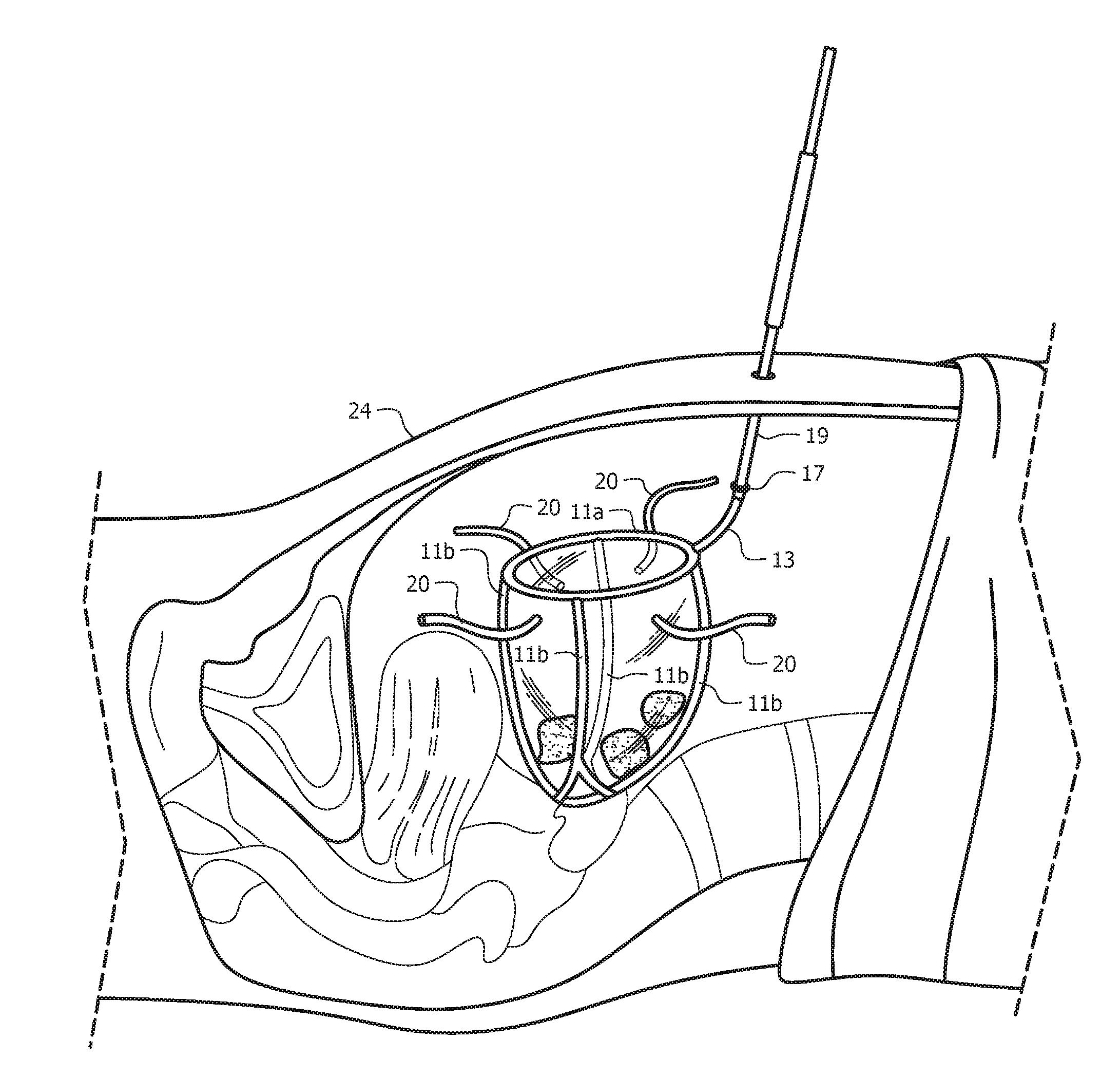 Pneumatic system and method for intermittently rigidifying an endoscopic specimen retaining carrier