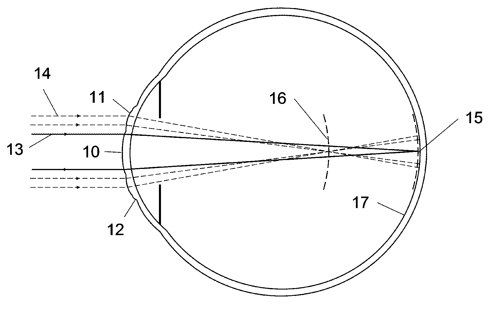 Contact lens and method for prevention of myopia progression