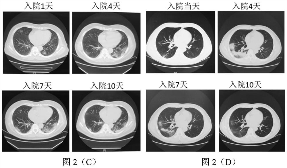 Marker for viral pneumonia and application of marker