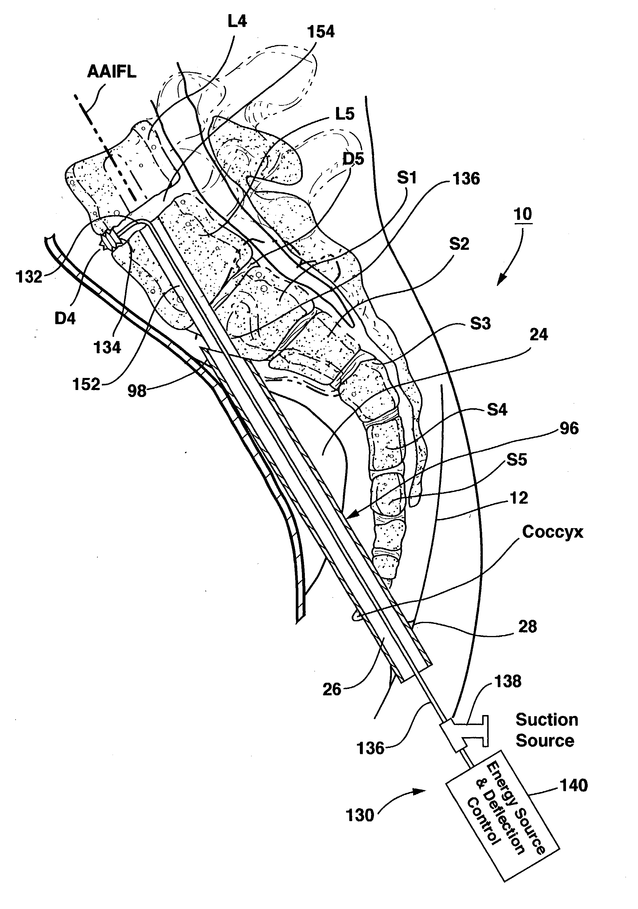 Methods and apparatus for performing therapeutic procedures in the spine