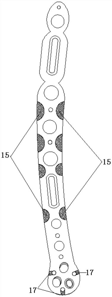 Distal humerus posterior-lateral bone fracture plate