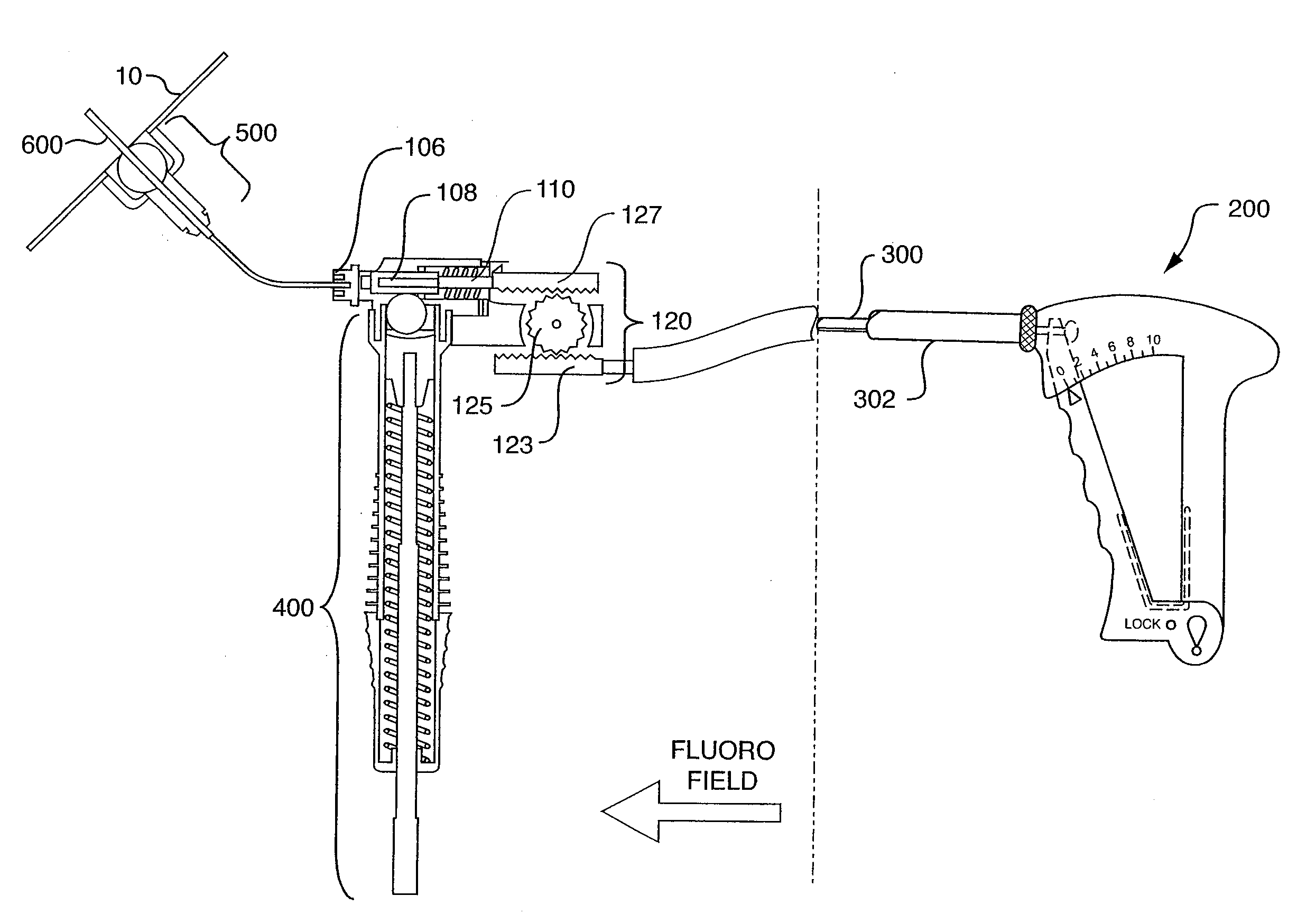 Remotely-activated vertebroplasty injection device