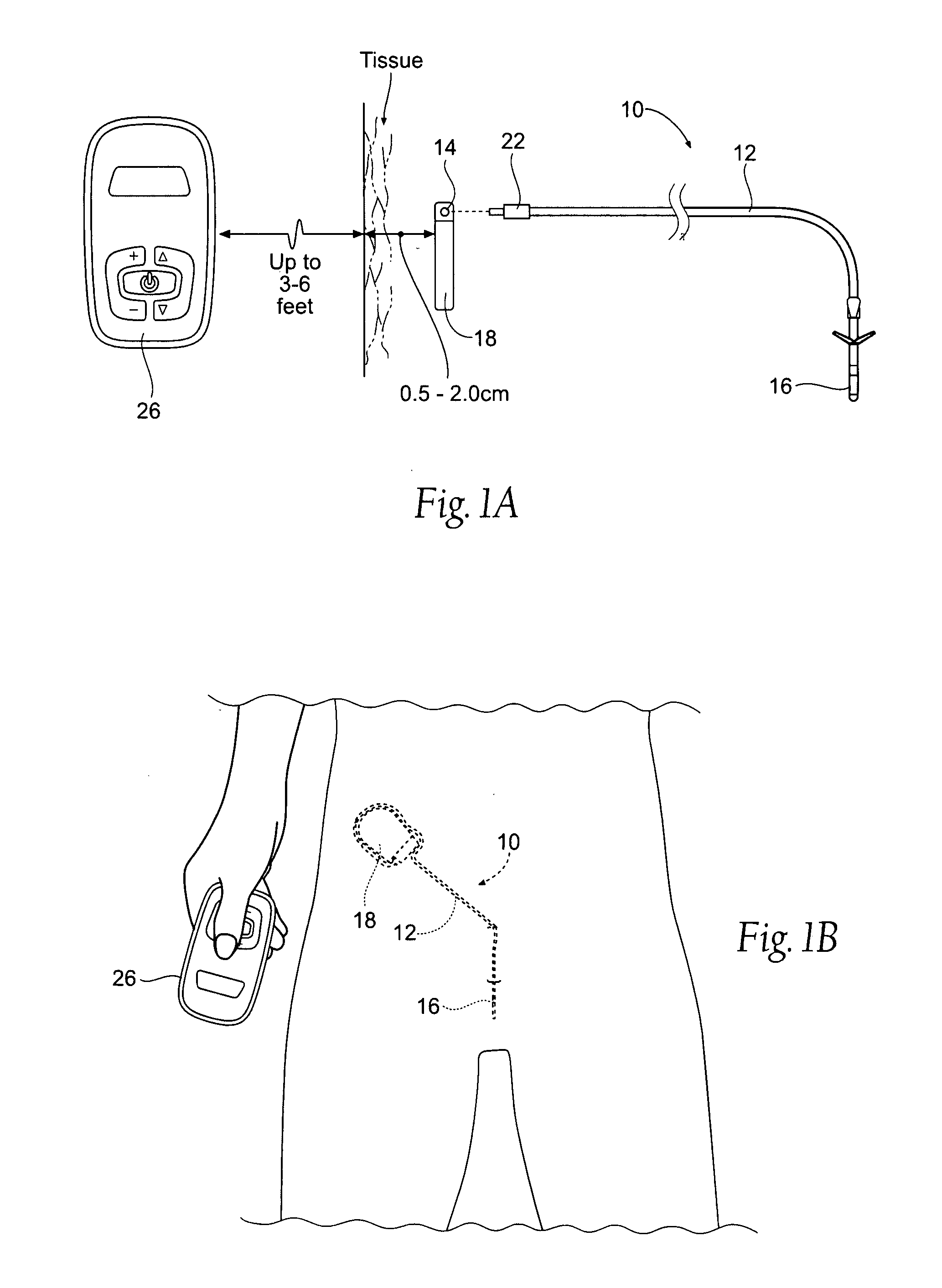 Systems and methods for bilateral stimulation of left and right branches of the dorsal genital nerves to treat urologic dysfunctions