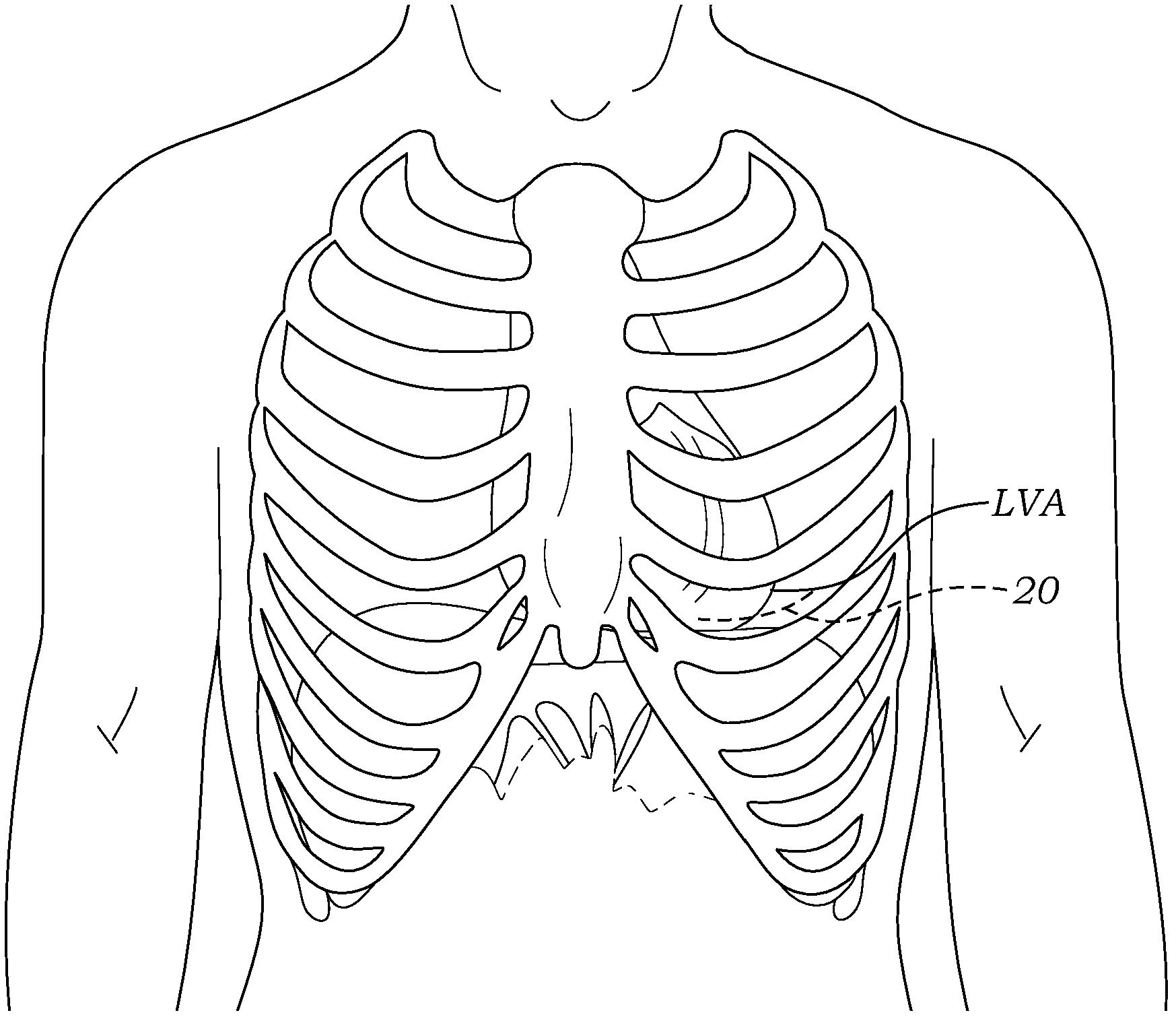 Apical delivery system for heart valves