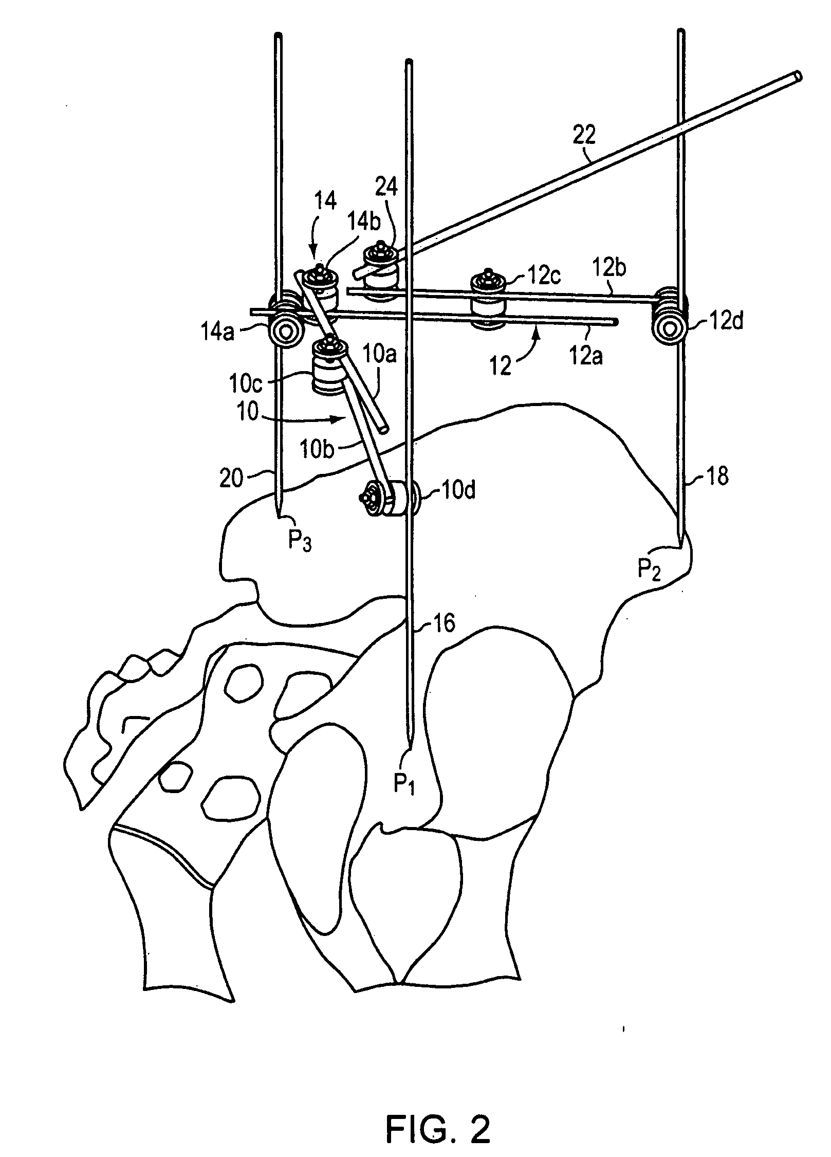 Method and apparatus for determining acetabular component positioning