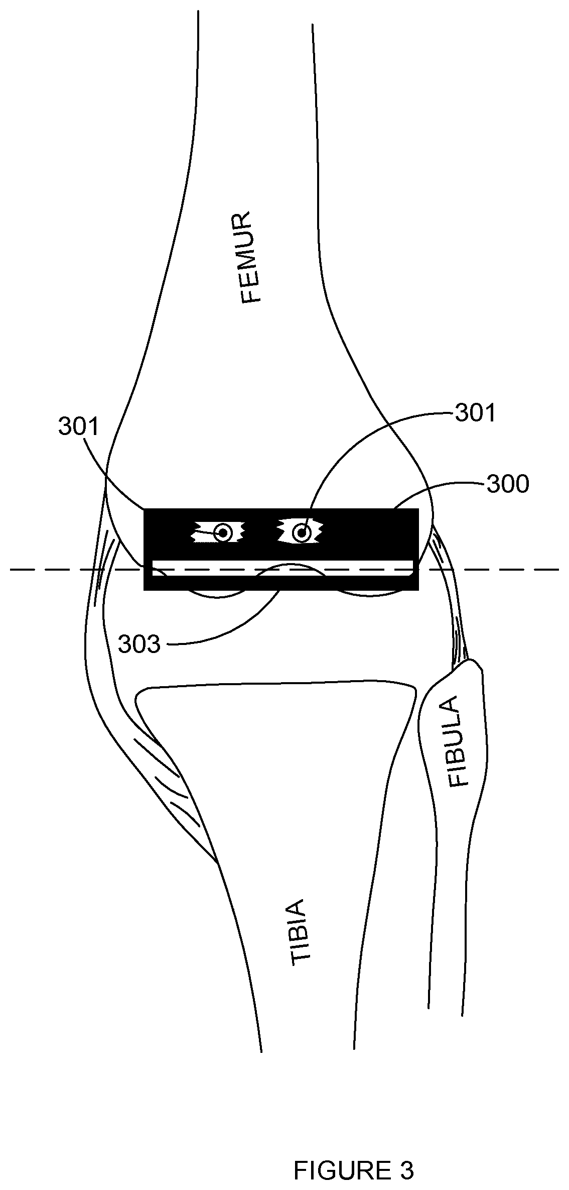 Soft Tissue Tension and Bone Resection Instruments and methods