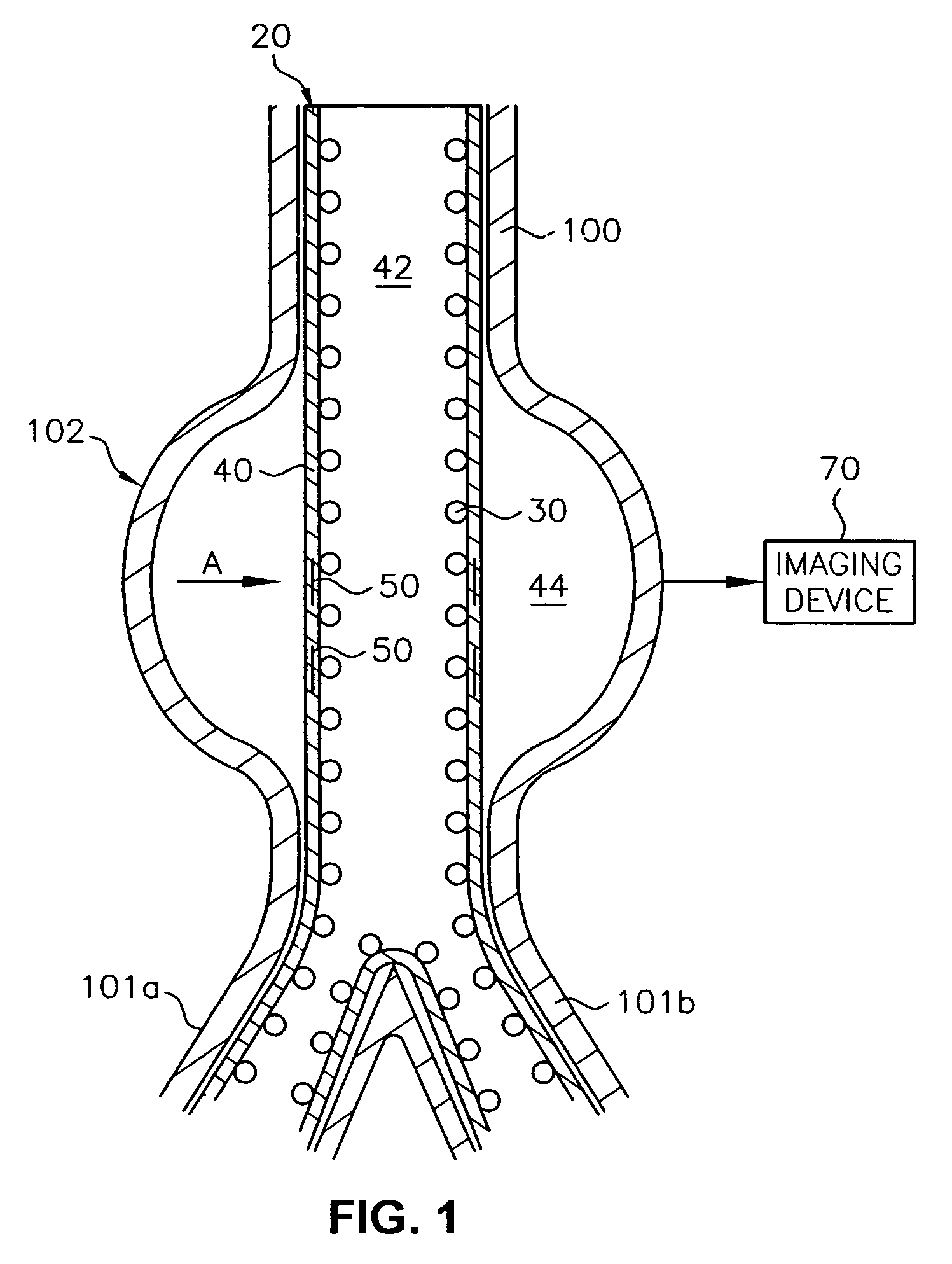 Endoluminal device and system and method for detecting a change in pressure differential across an endoluminal device