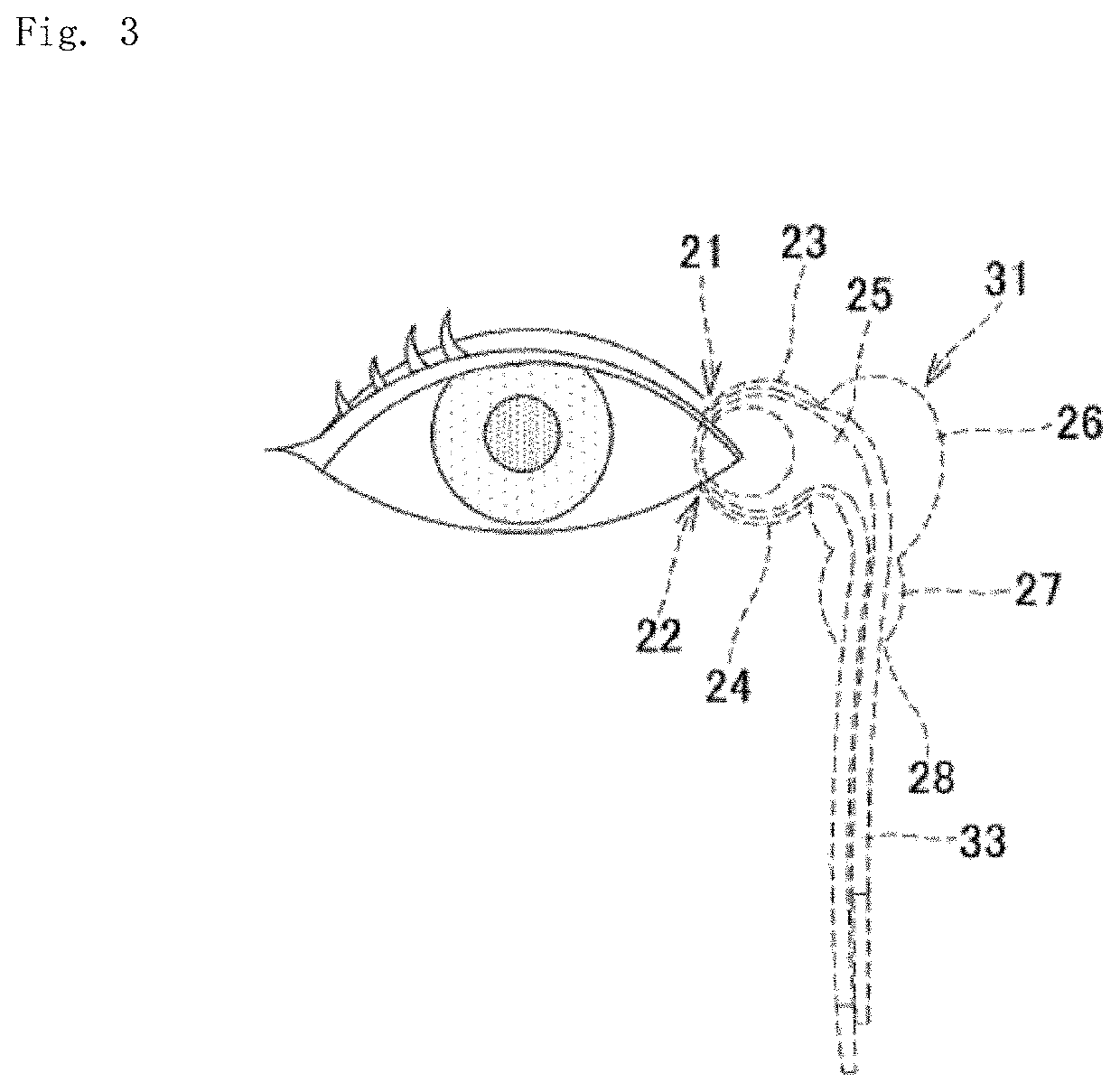 Lacrimal duct tube