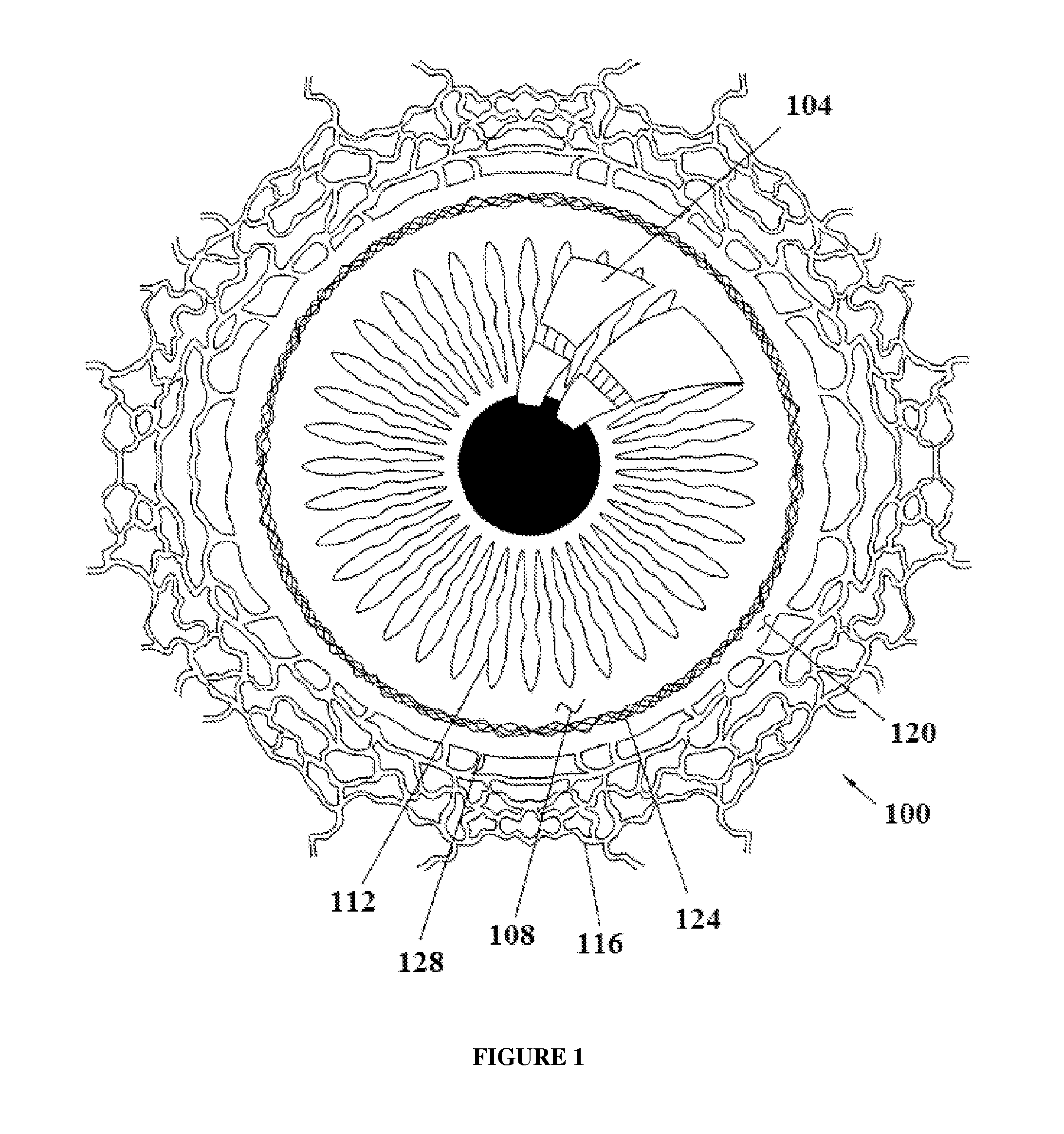 Implants for reducing intraocular pressure