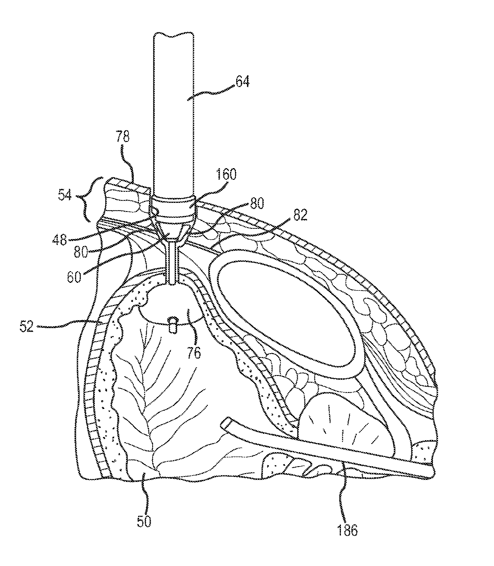 Method for placing a cannula in a bladder