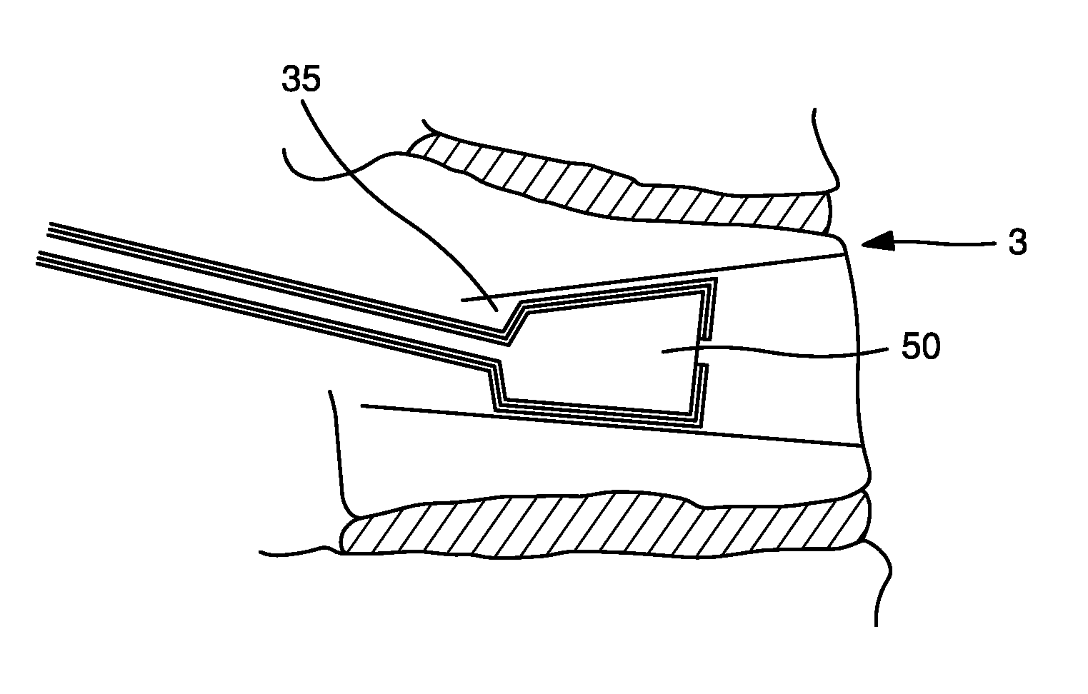 Devices and methods for the treatment of bone fracture