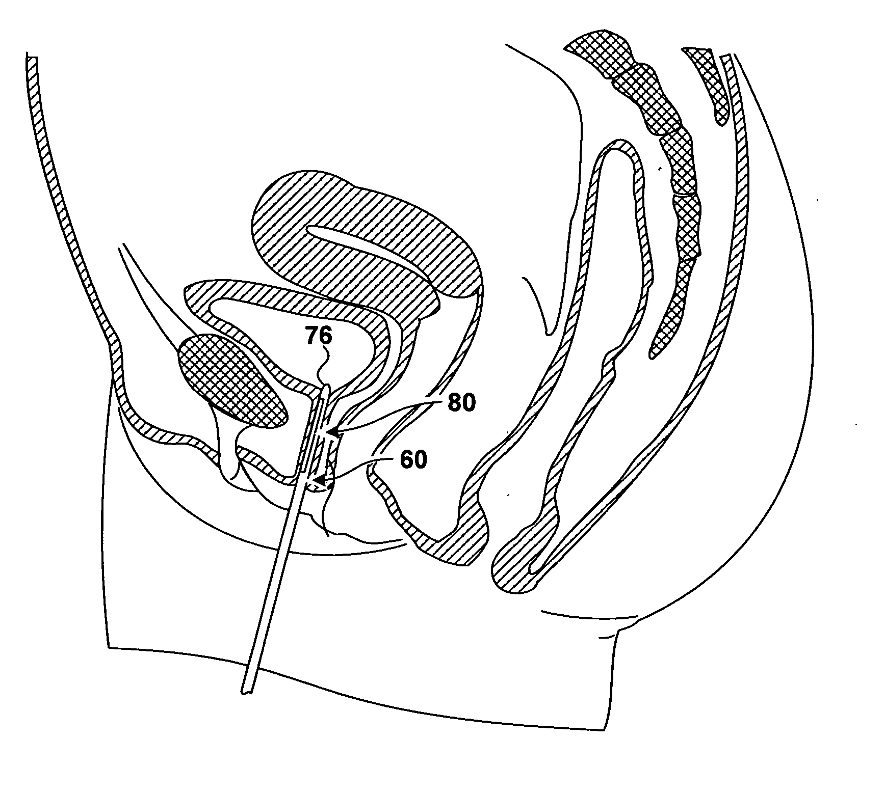 Implantable devices and methods for treating urinary incontinence