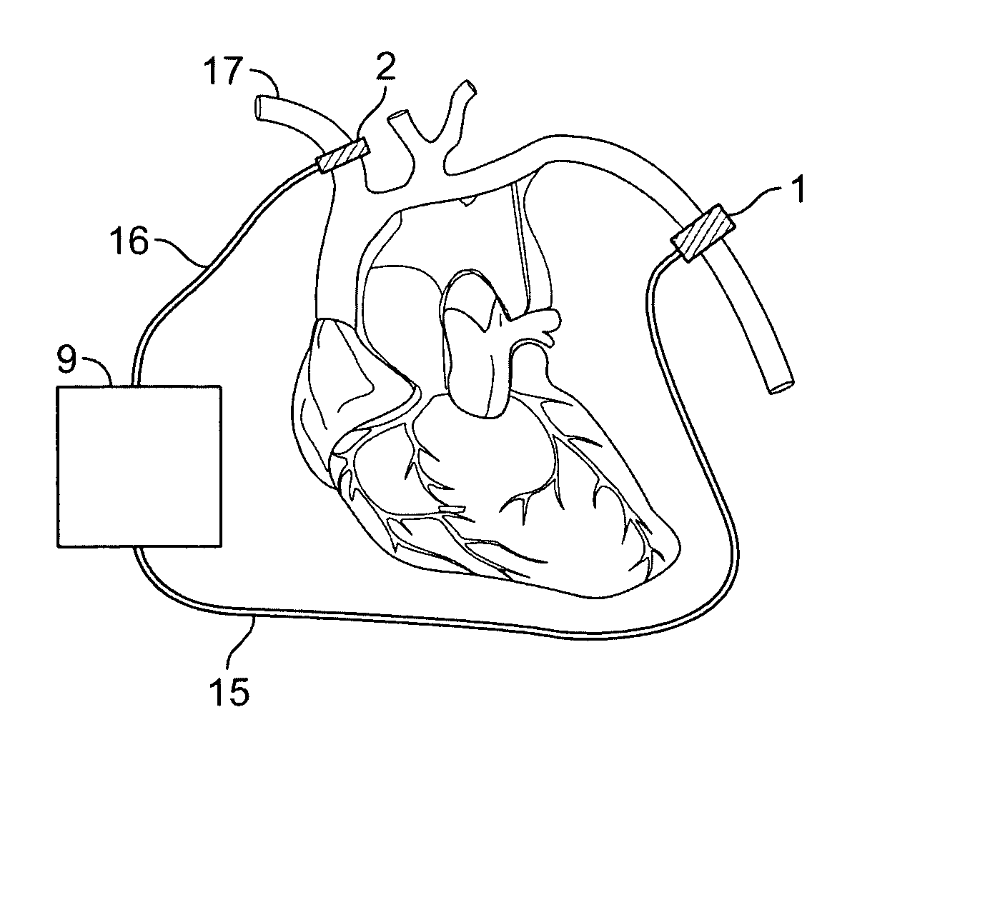 Devices for counteracting hypotension