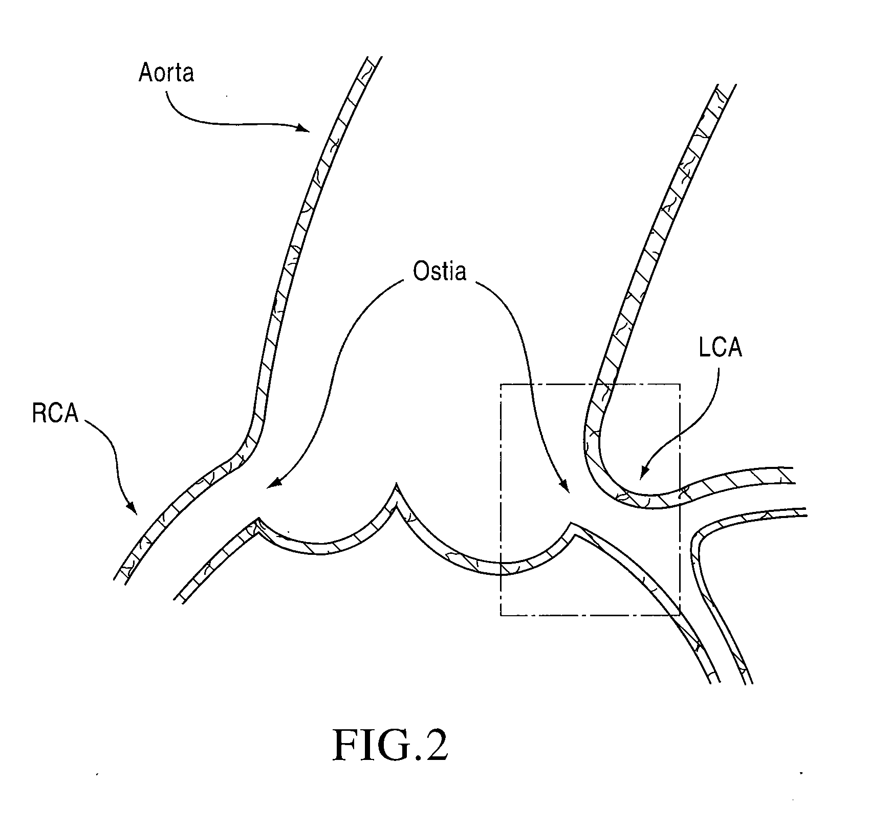 Apparatuses and methods to treat atherosclerotic plaques