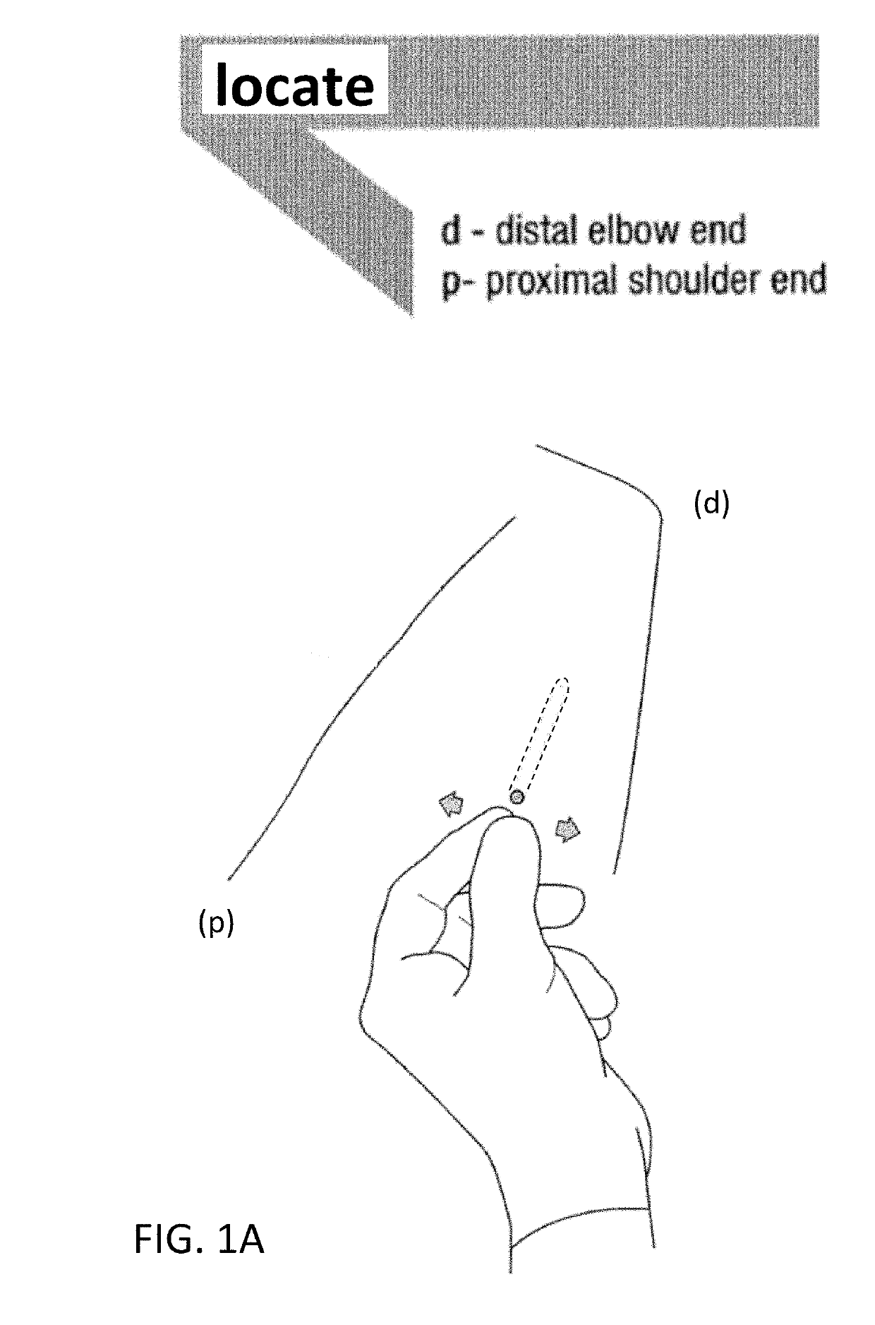 Device for Removing an Item Implanted Underneath the Skin