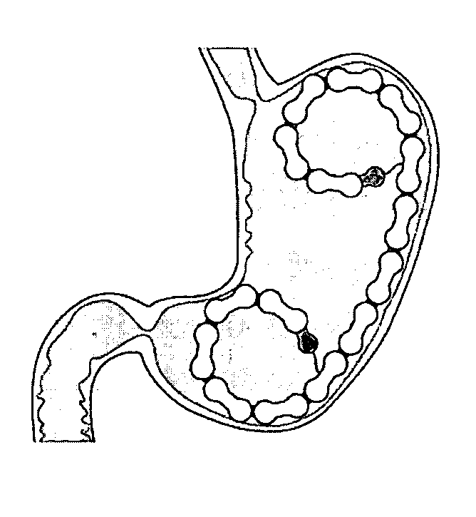 Method for inducting weight loss using a coil for insertion into a hollow body organ