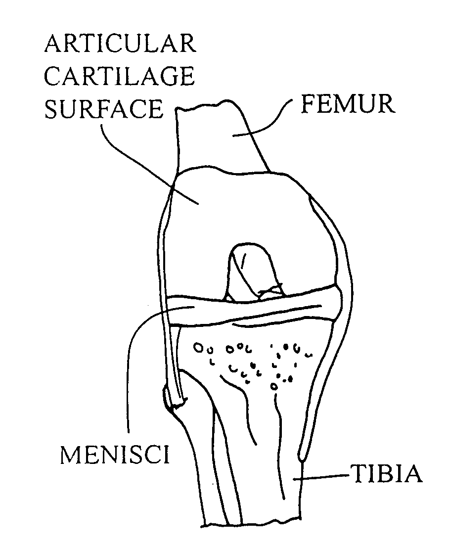 Cartilage implant plug with fibrin glue and method for implantation