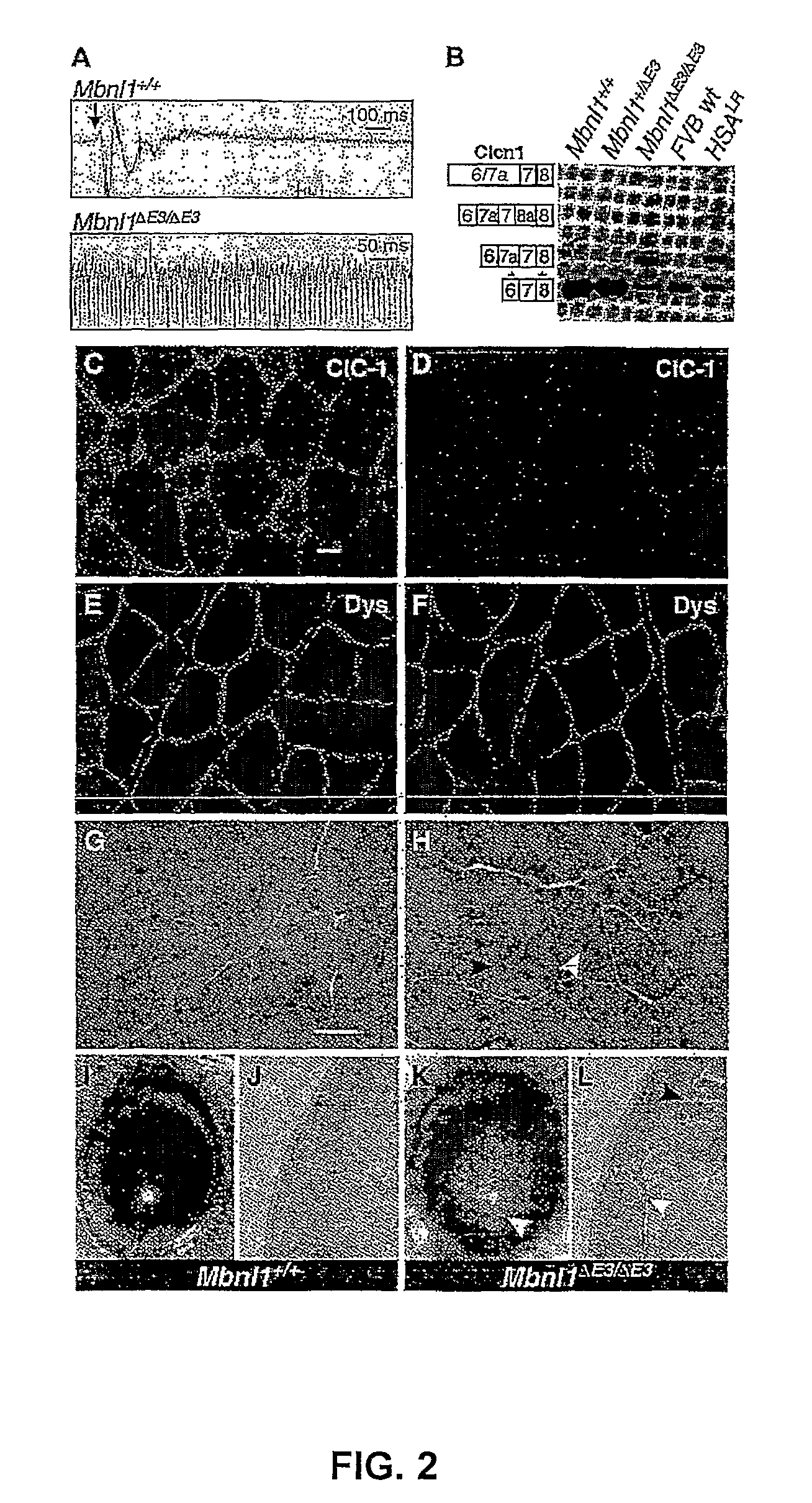 Methods and compositions for treatment of myotonia
