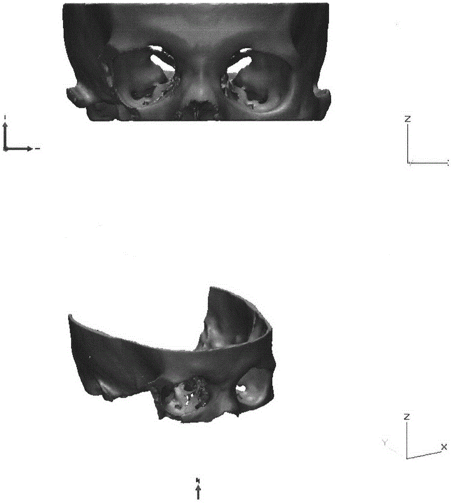 Head maxillofacial bone implant and method for quickly molding same