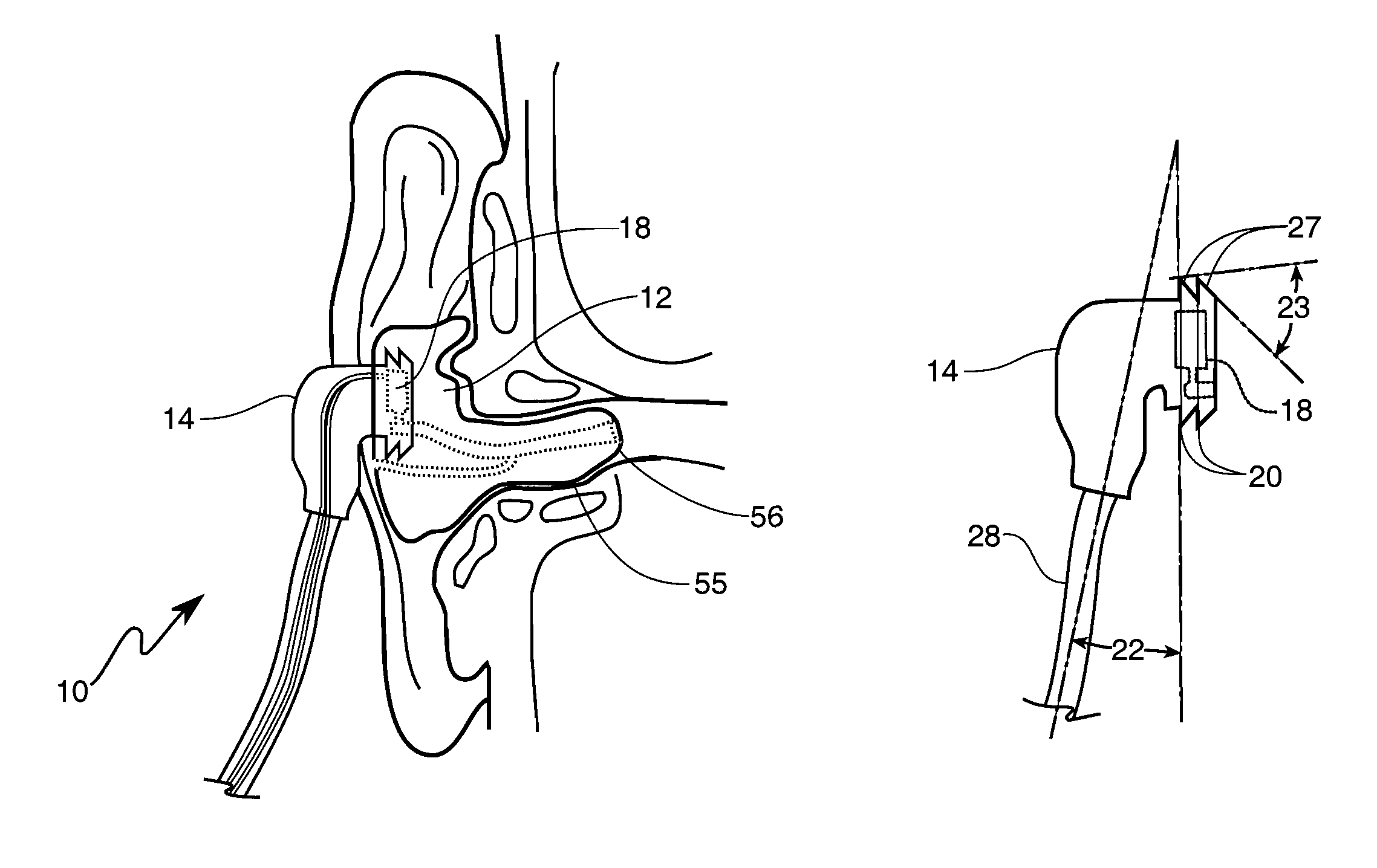 Deep insertion vented earpiece system