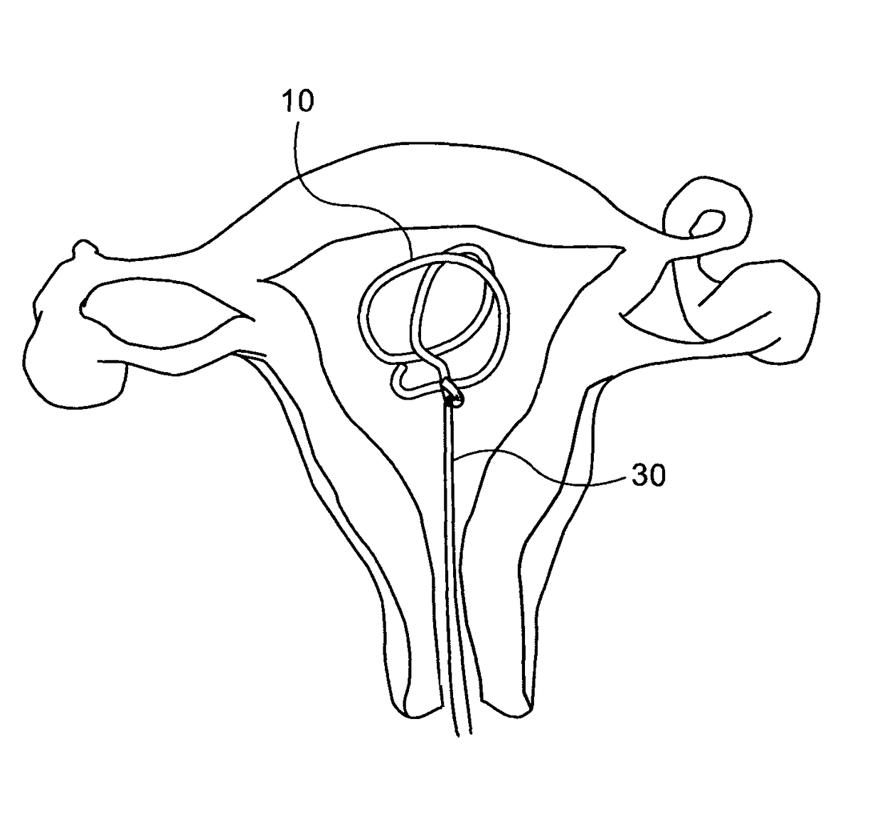 Intra uterine device
