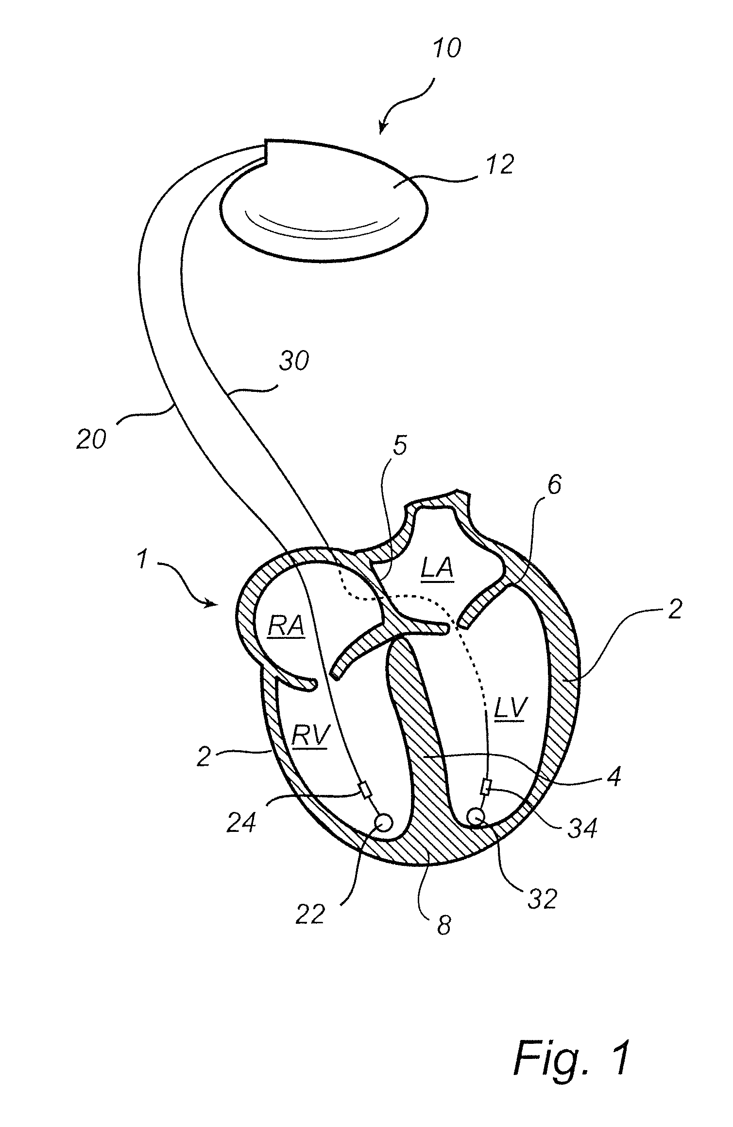 Implantable medical device and method for monitoring synchronicity of the ventricles of a heart