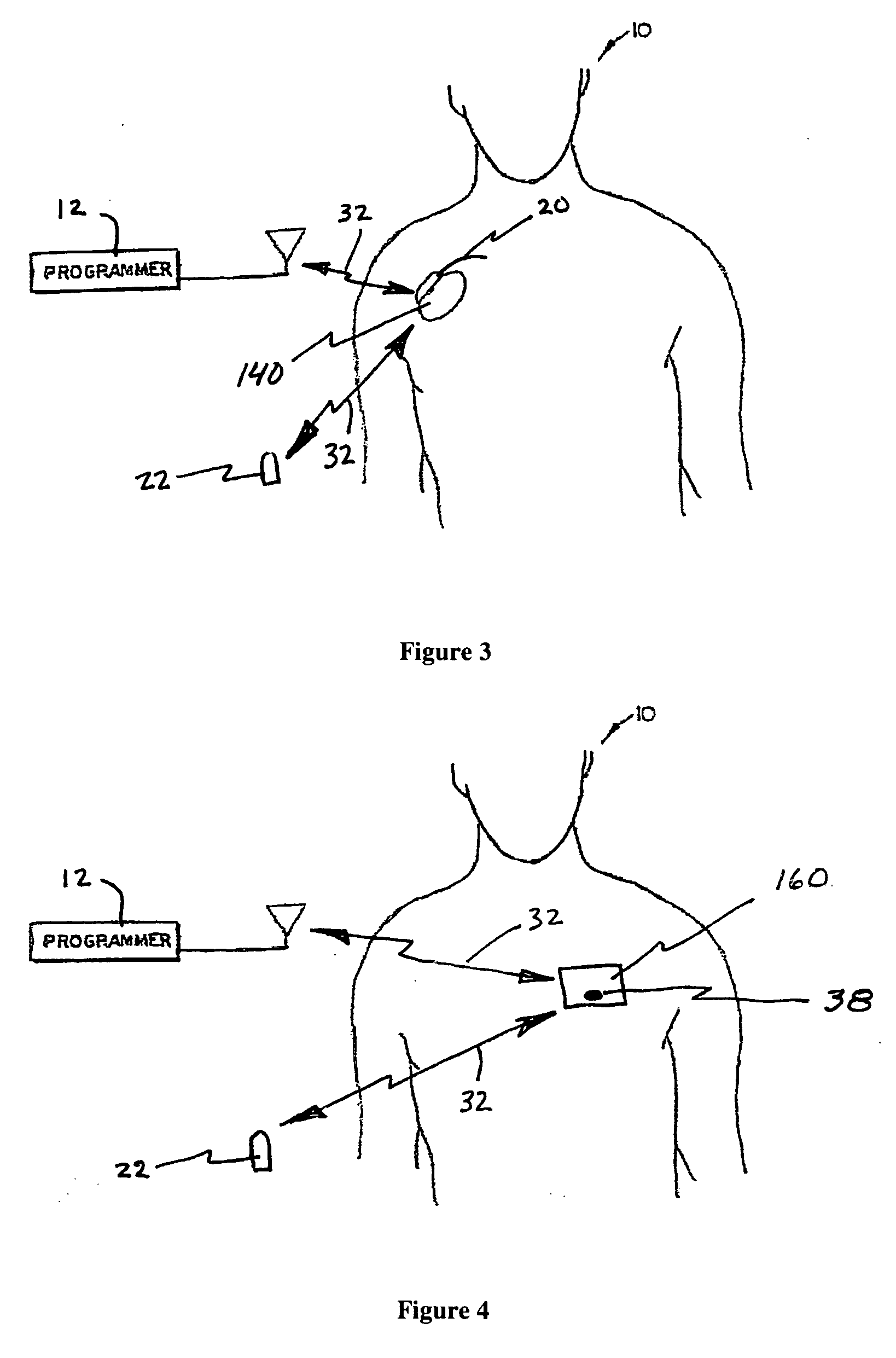System and method for regulating cardiac triggered therapy to the brain