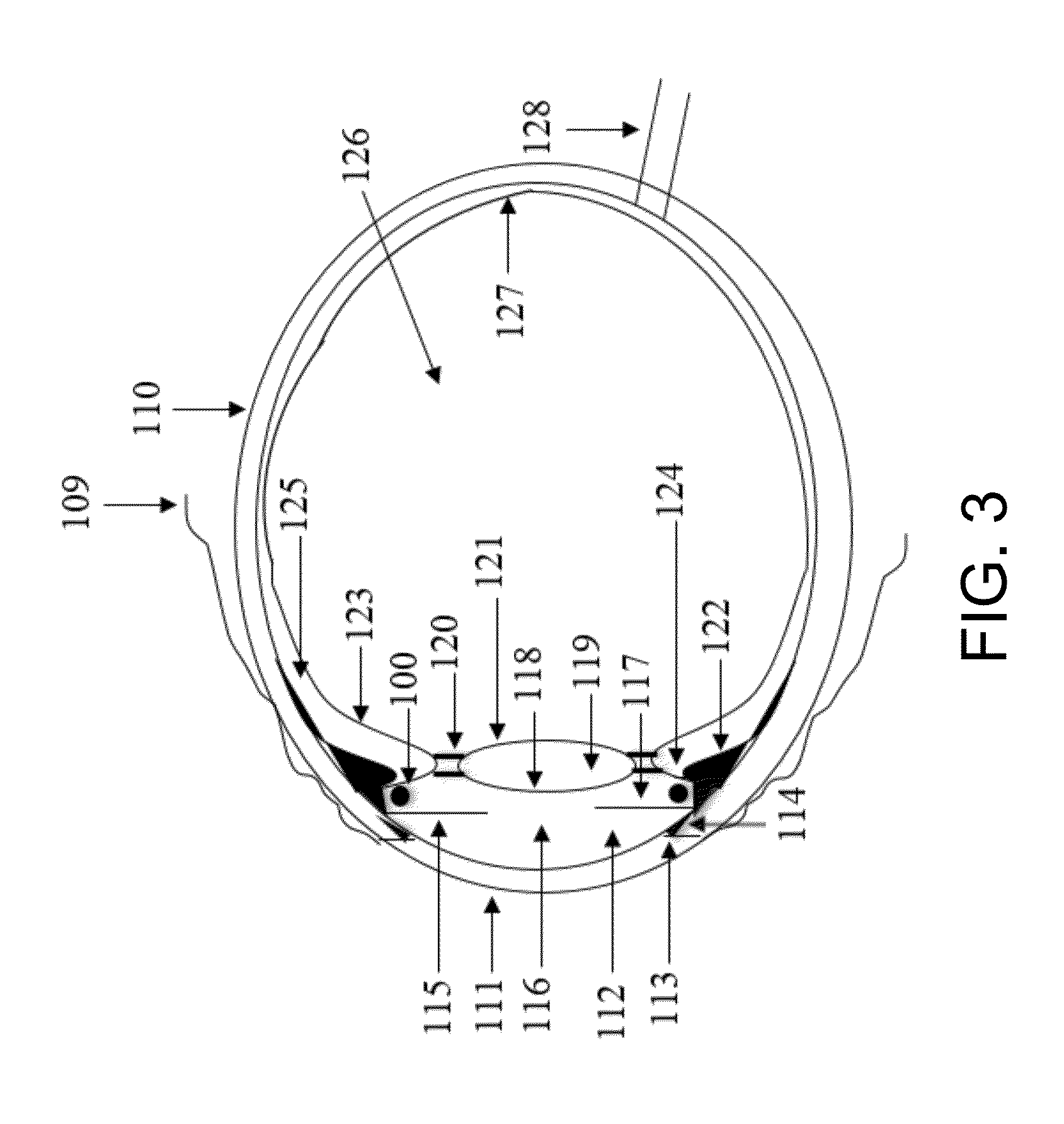 Device and method for ciliary muscle compression for increasing the amplitude of accommodation