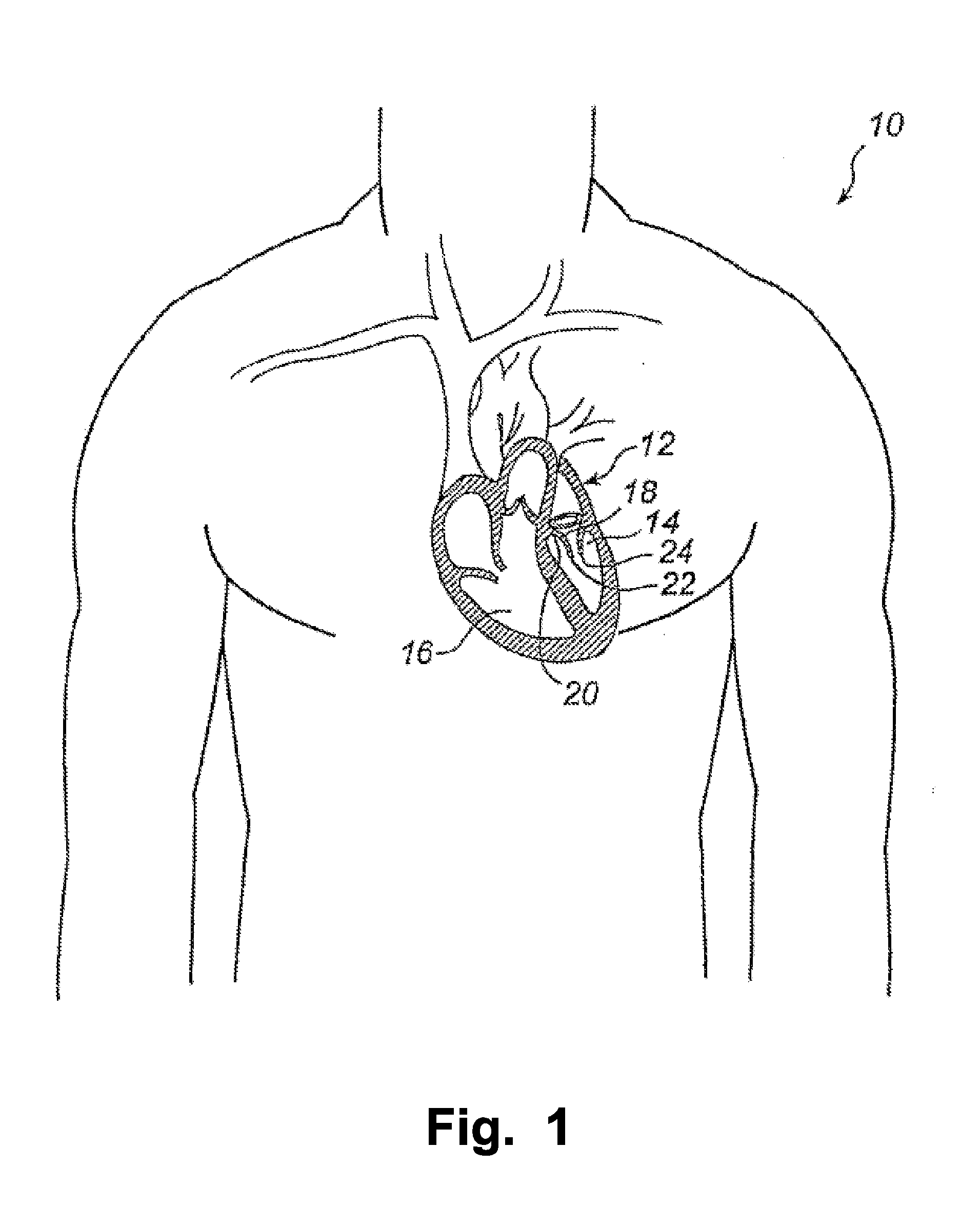 Device And Method For Improving Function Of Heart Valve