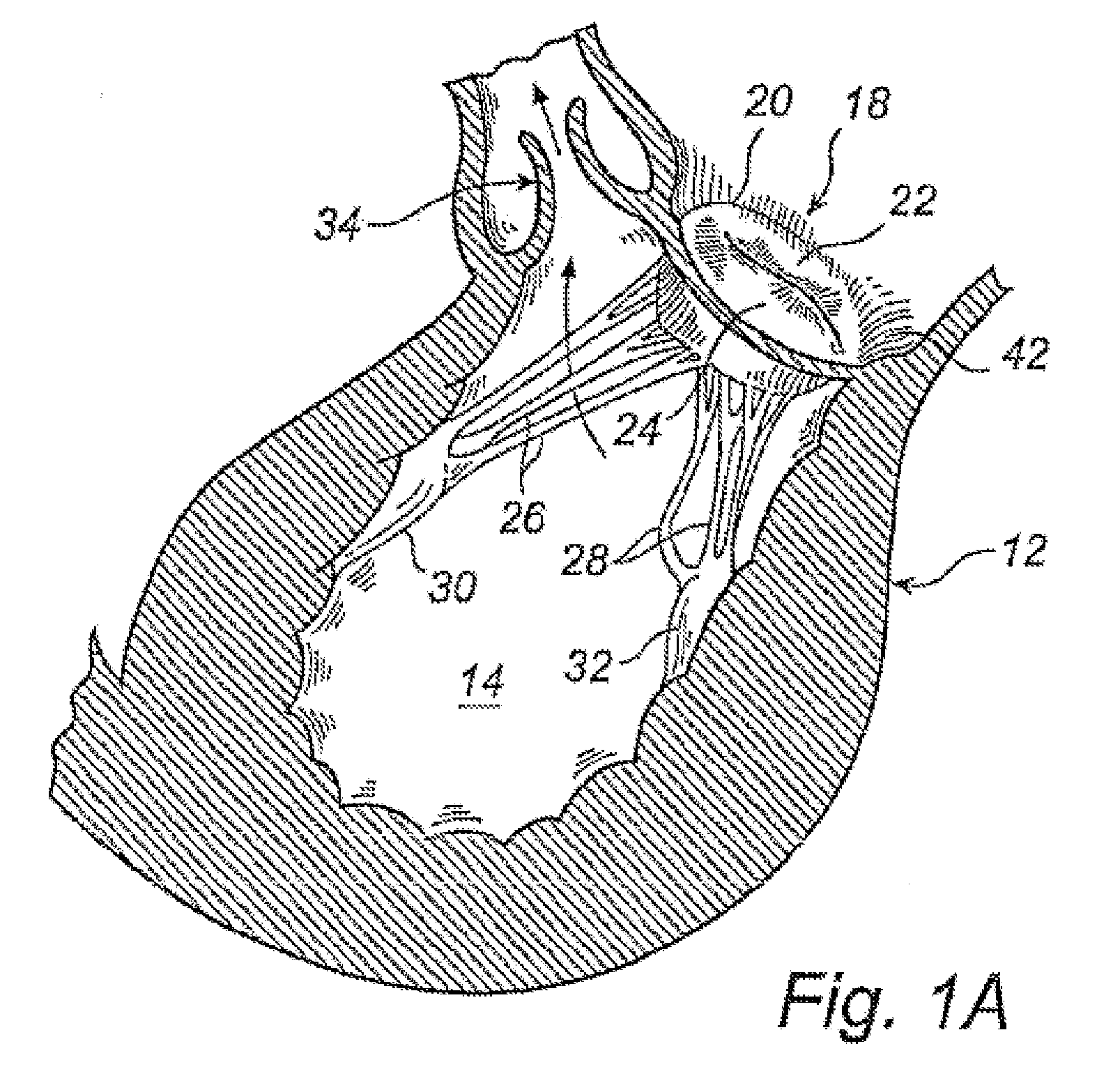 Device And Method For Improving Function Of Heart Valve