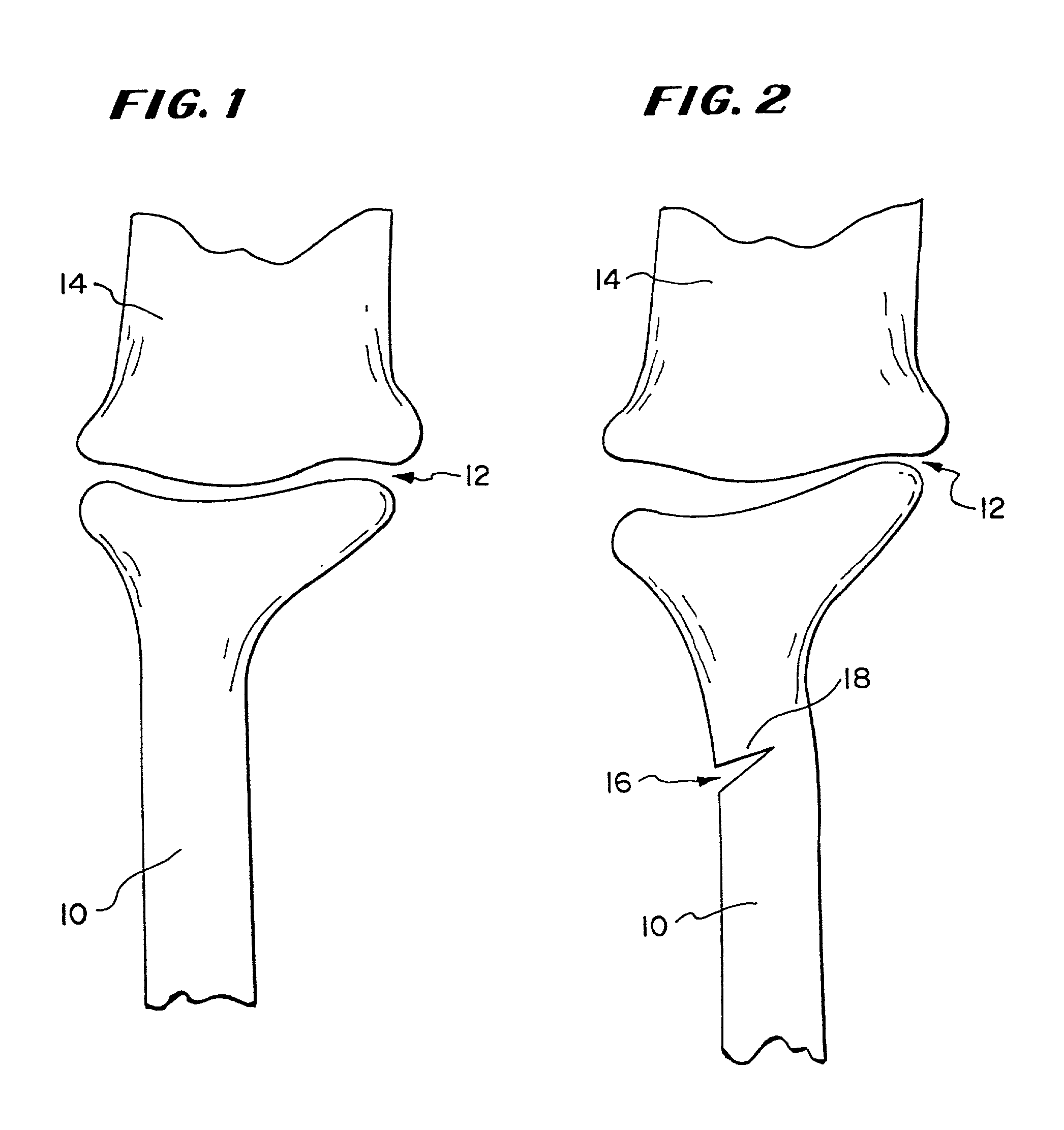 Systems and methods using expandable bodies to push apart cortical bone surfaces