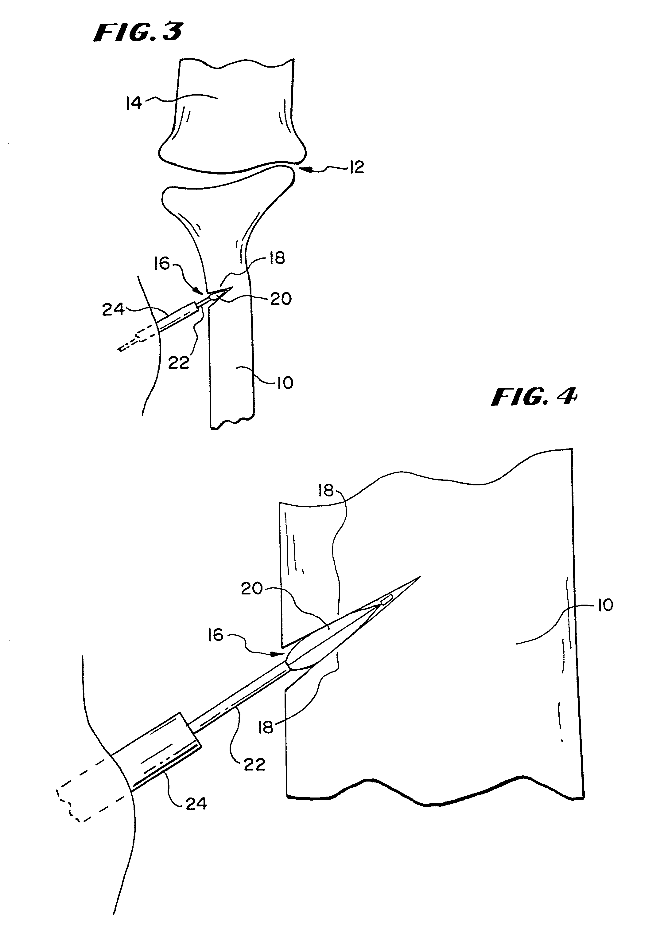 Systems and methods using expandable bodies to push apart cortical bone surfaces