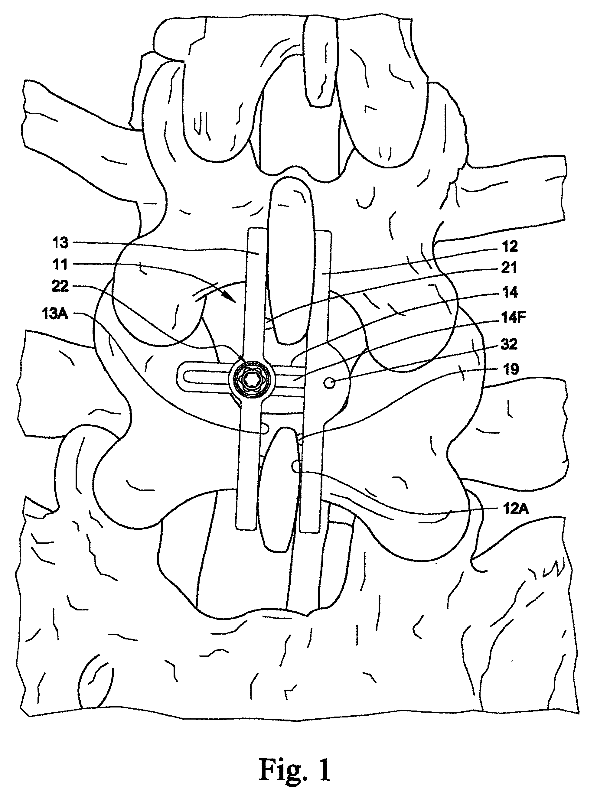 Device for fixation of spinous processes