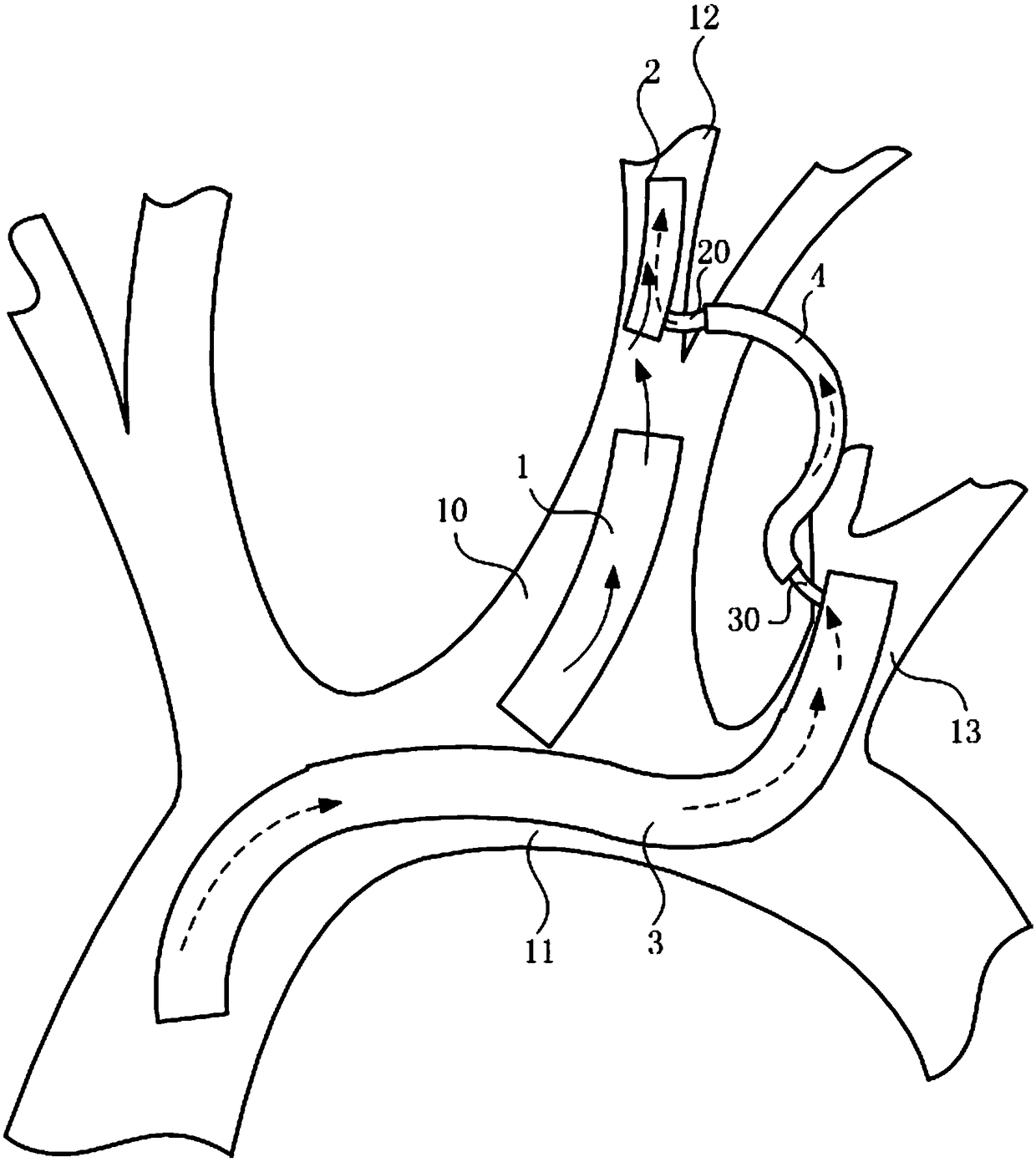 Device for intracranial bypass of aorta and left internal carotid artery