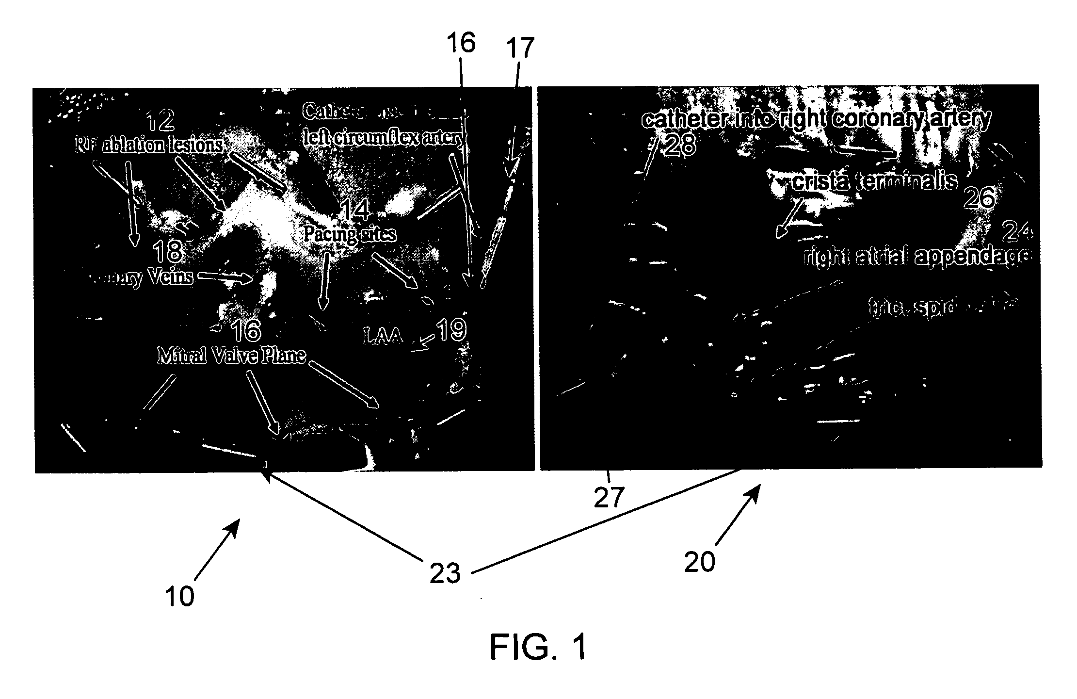 Method and associated system for the interventional treatment of atrial fibrillation