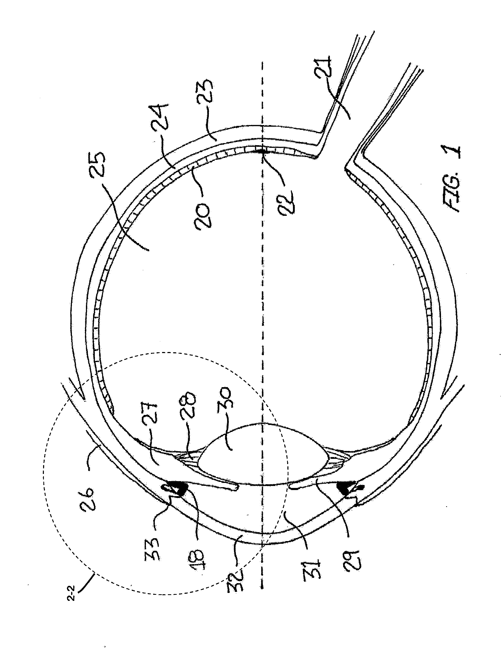Ocular Collar Stent for Treating Narrowing of the Irideocorneal Angle