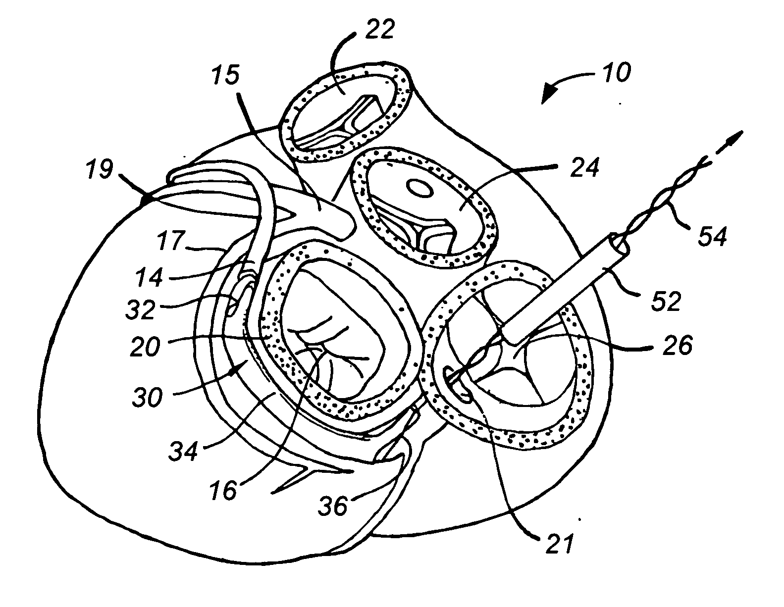Fixed length anchor and pull mitral valve device and method