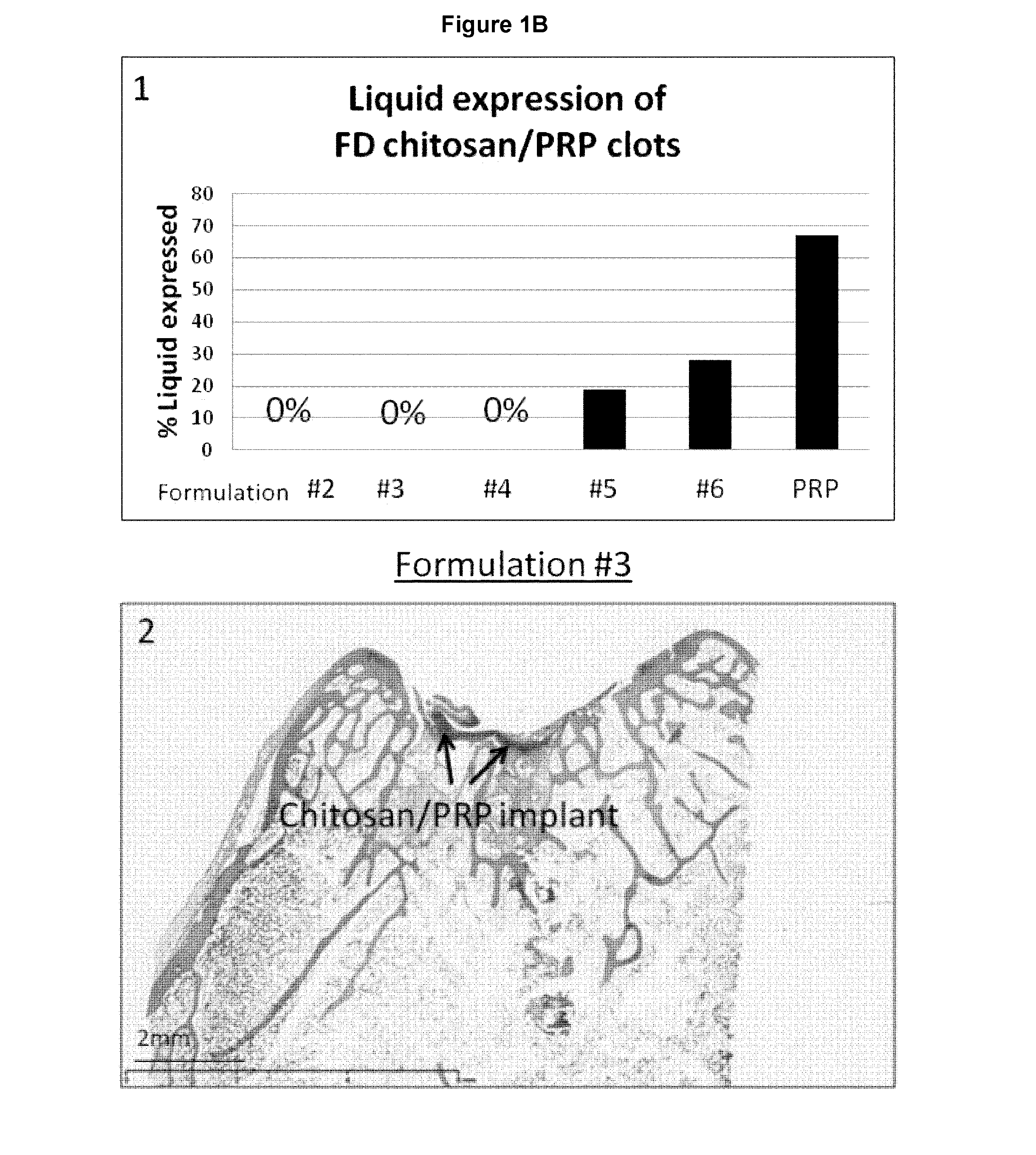 Freeze-dried polymer compositions for mixing with platelet rich plasma to form implants for tissue repair and/or compositions for therapeutic intra-articular injections