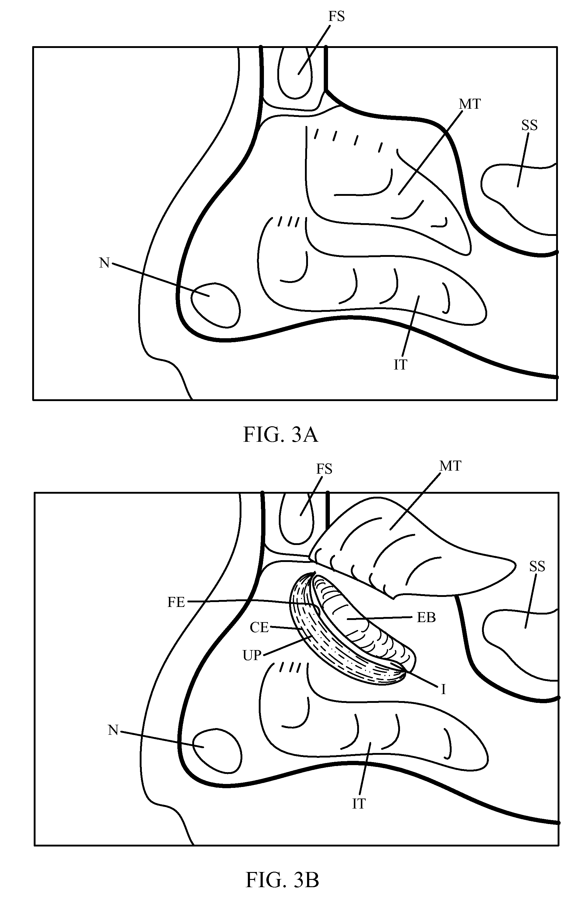 Method and device for remodeling the uncinate process