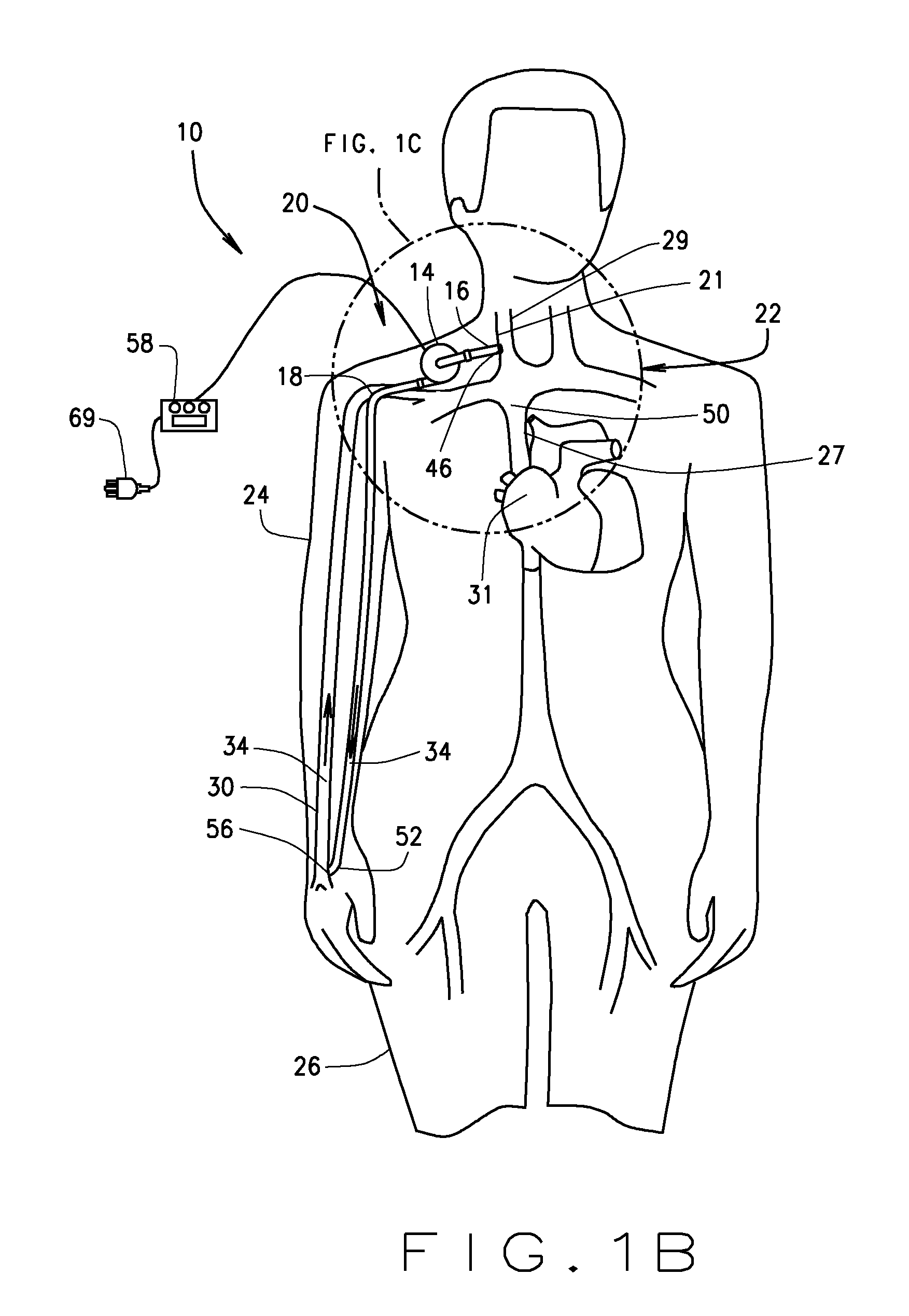 System and method to increase the overall diameter of veins and arteries