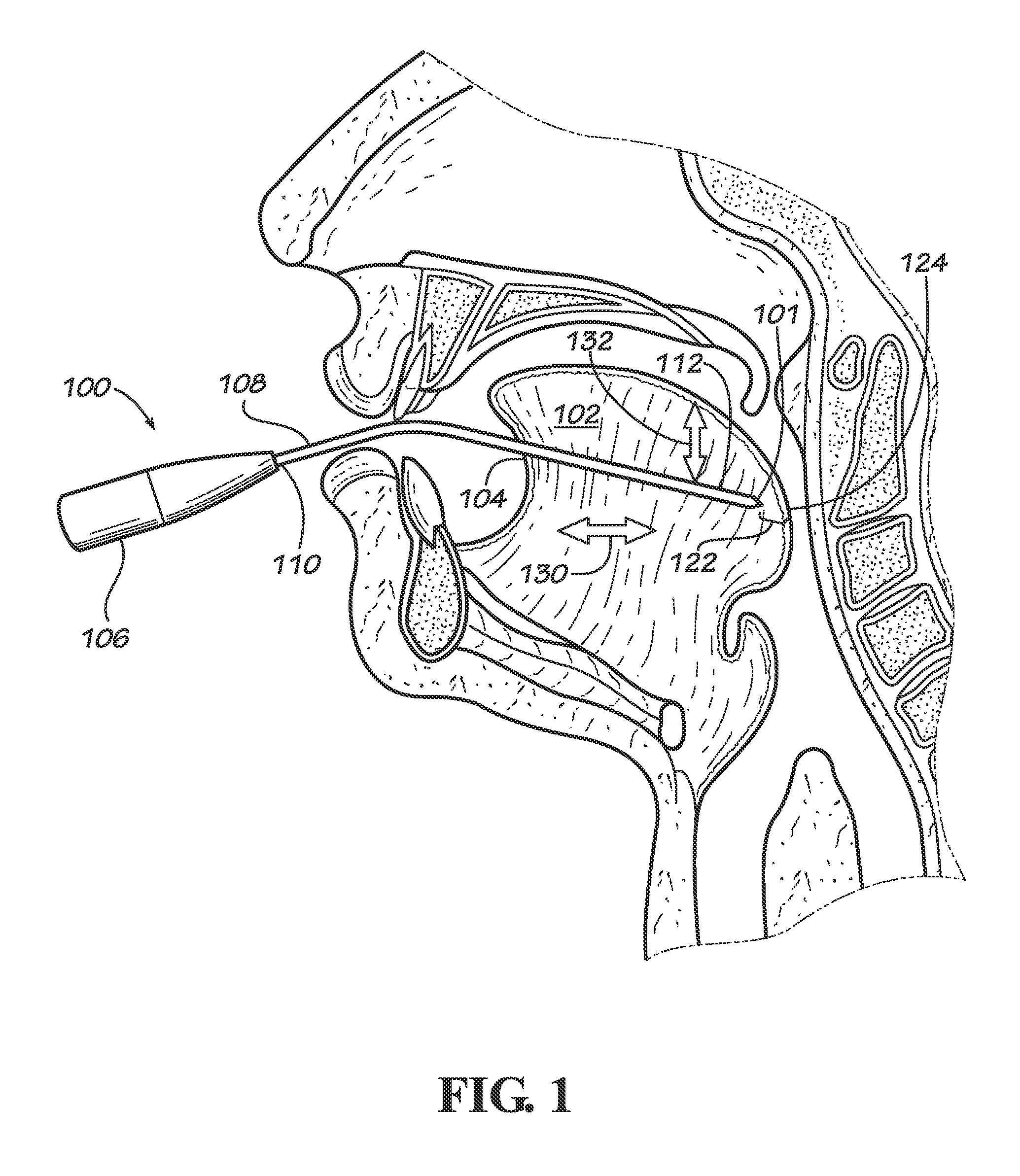 Apparatus and method for ventral only ablation of the tongue