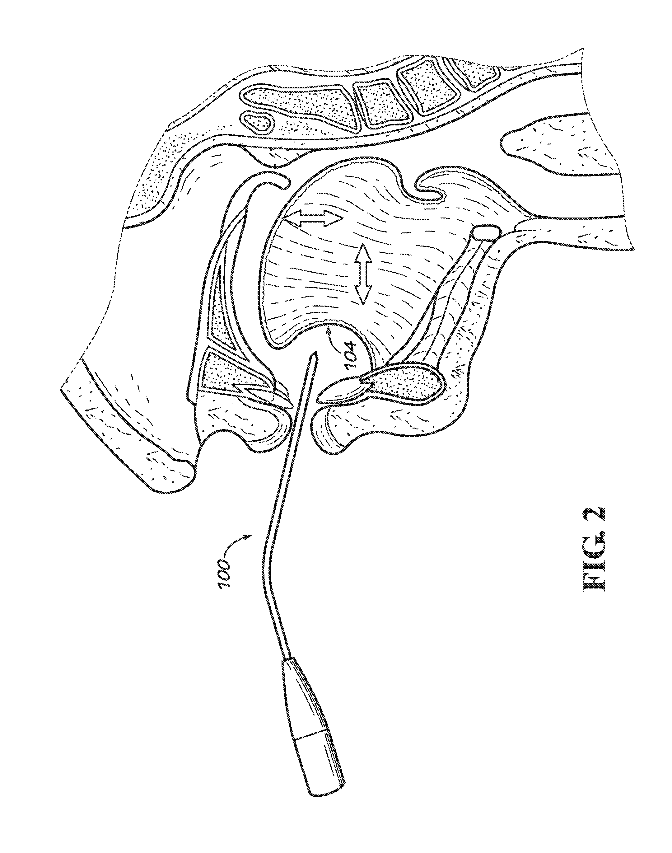 Apparatus and method for ventral only ablation of the tongue