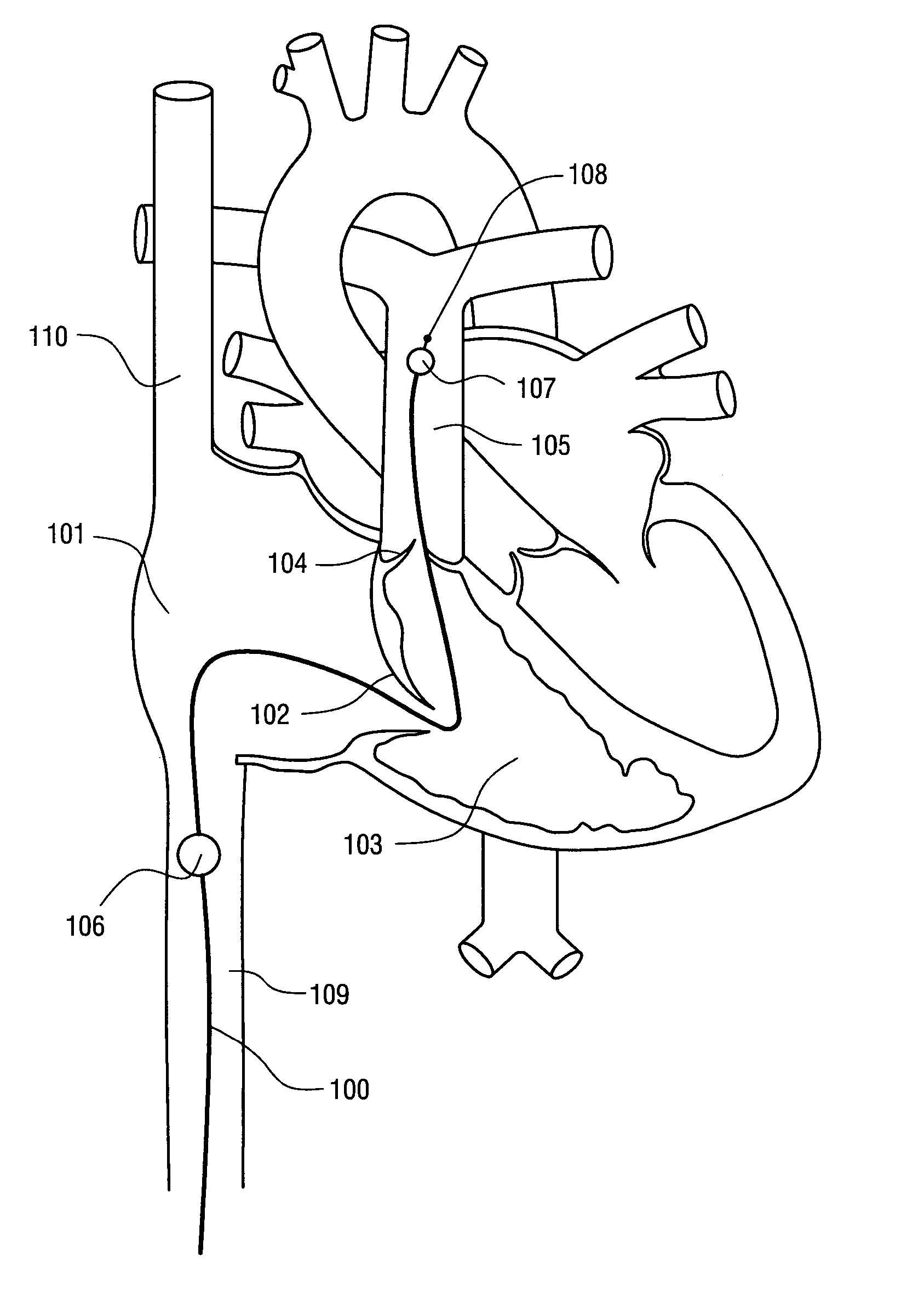 Treatment of infarct expansion by partially occluding vena cava