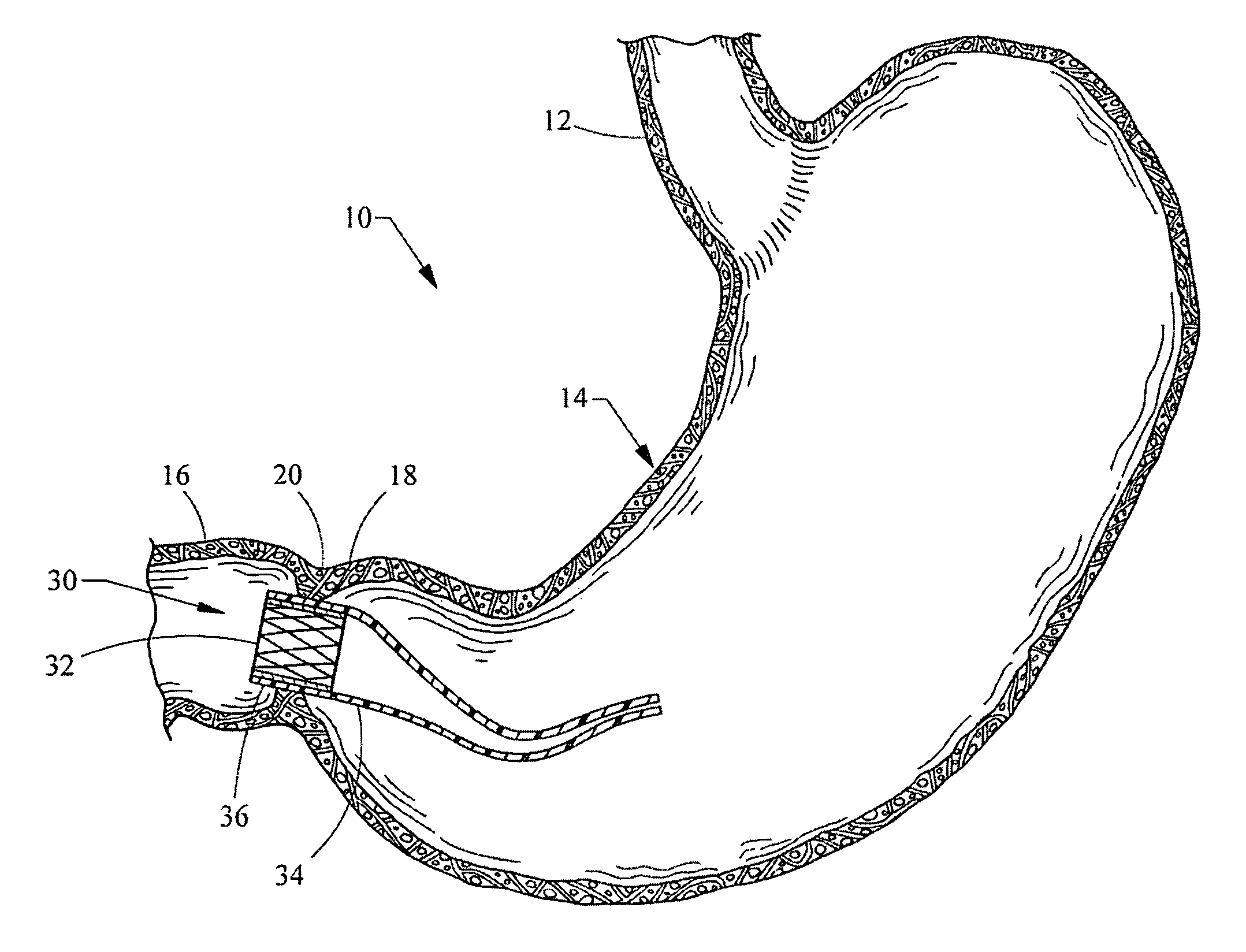 Apparatus and methods for delaying gastric emptying to treat obesity