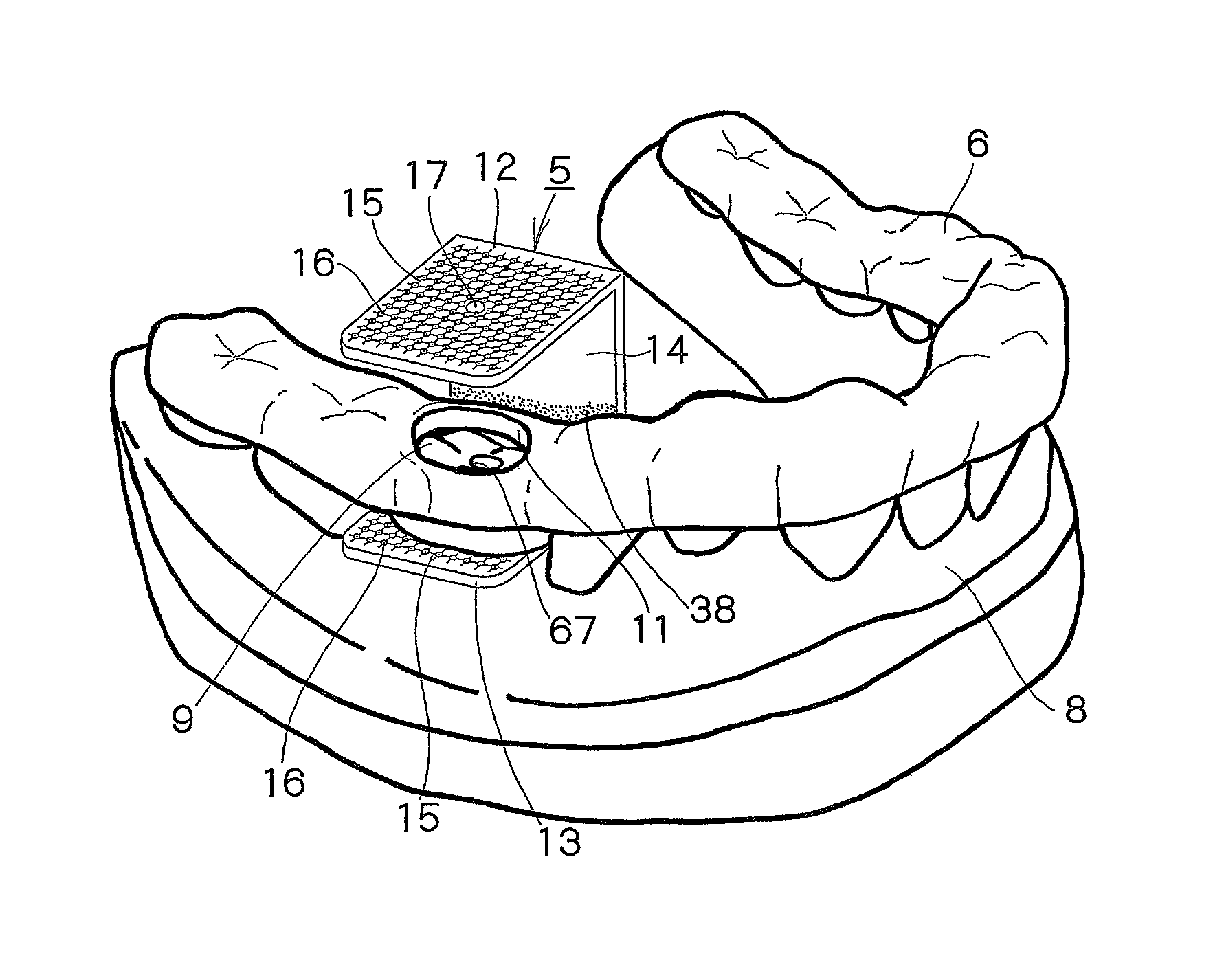 Surgical guide preparation tool and method for preparing surgical guide