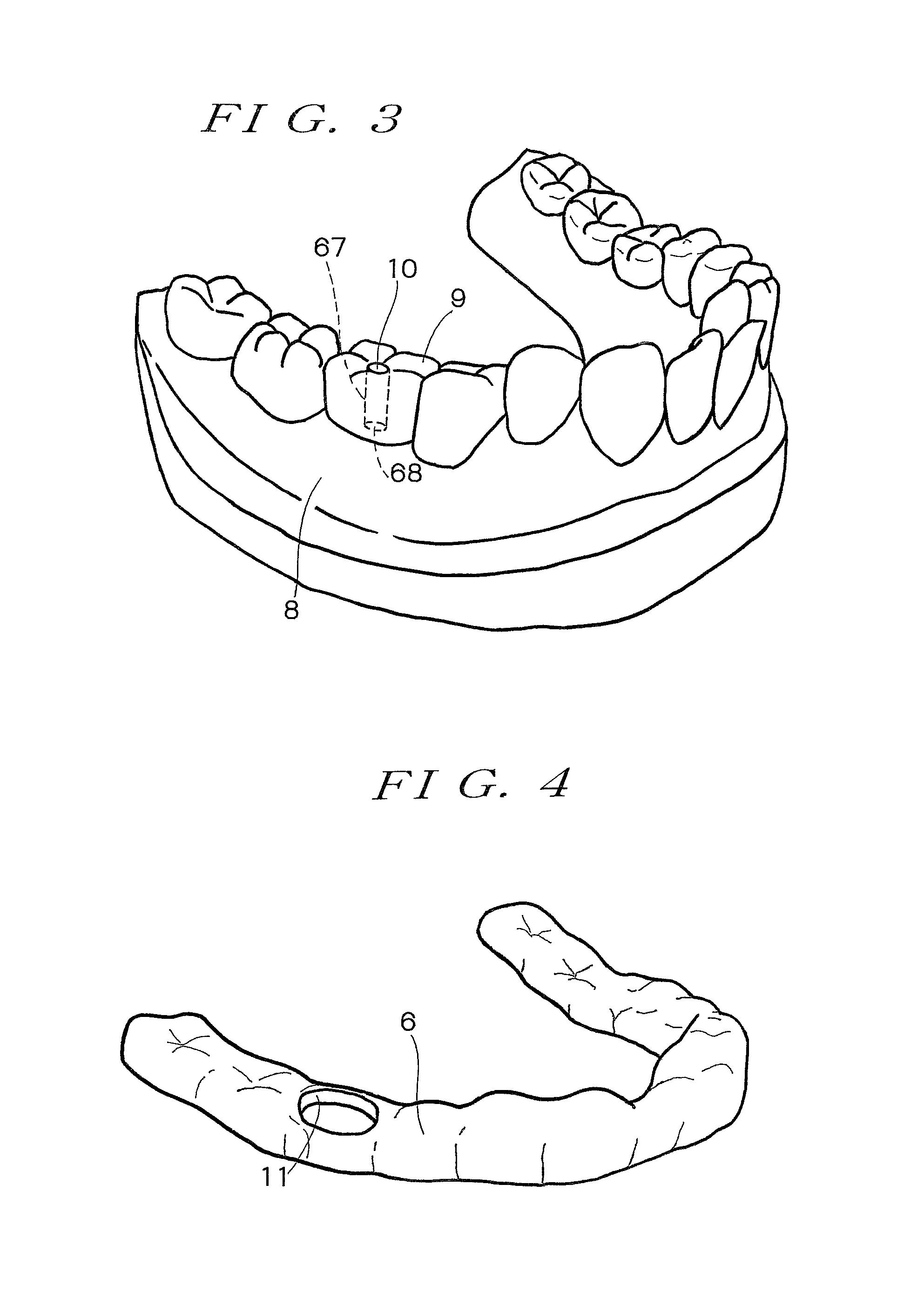 Surgical guide preparation tool and method for preparing surgical guide