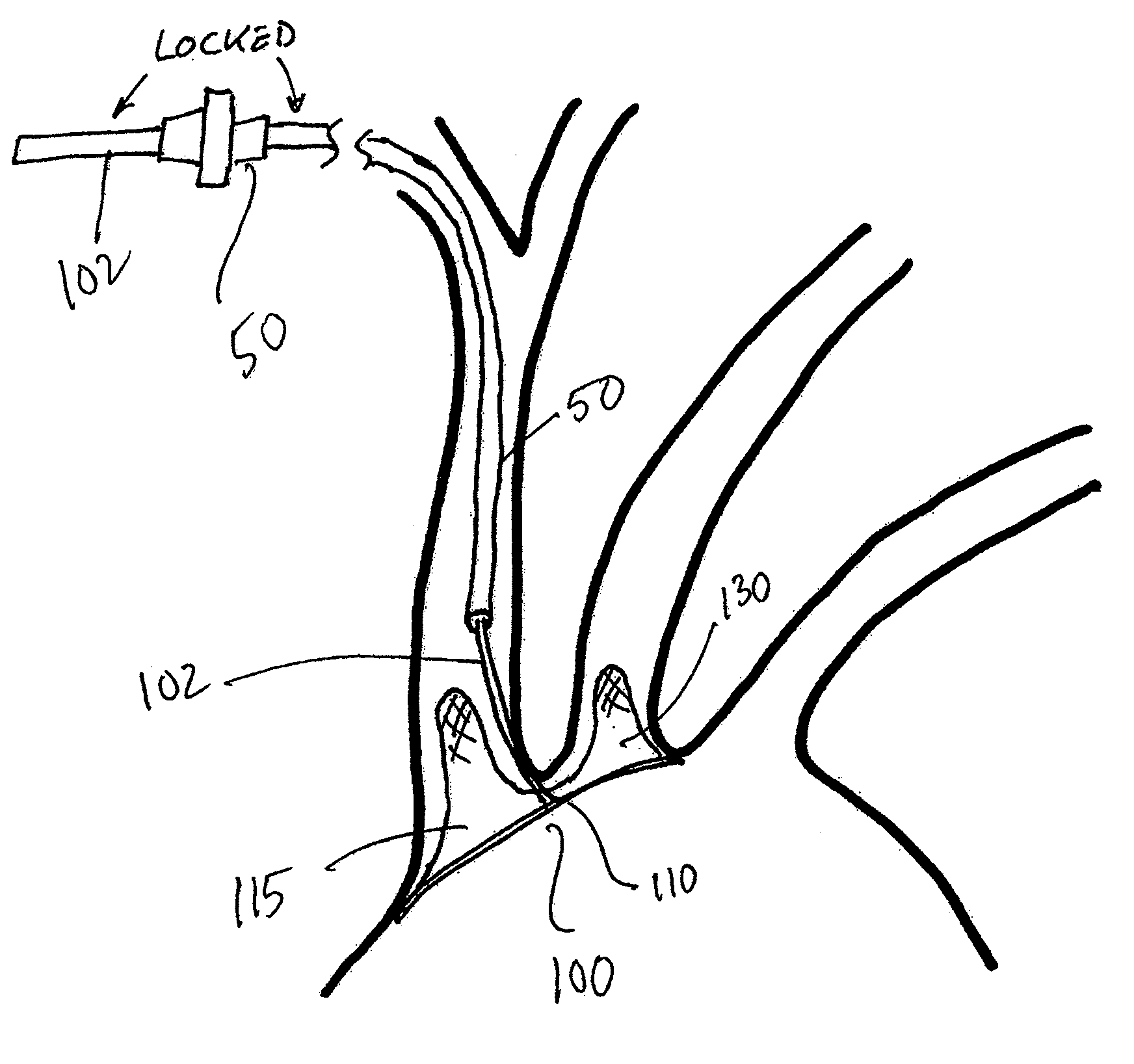 Dual Endovascular Filter and Methods of Use