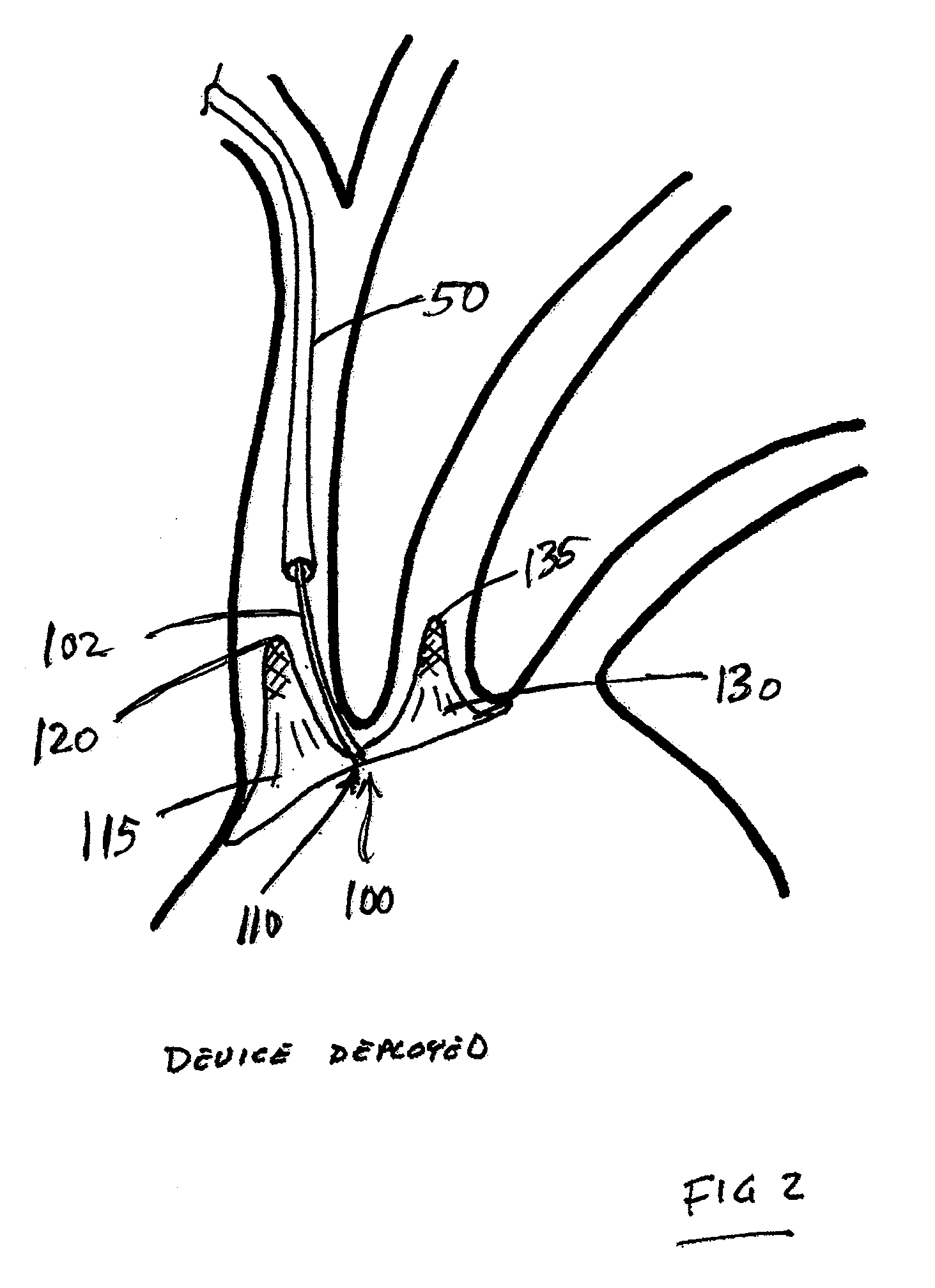 Dual Endovascular Filter and Methods of Use