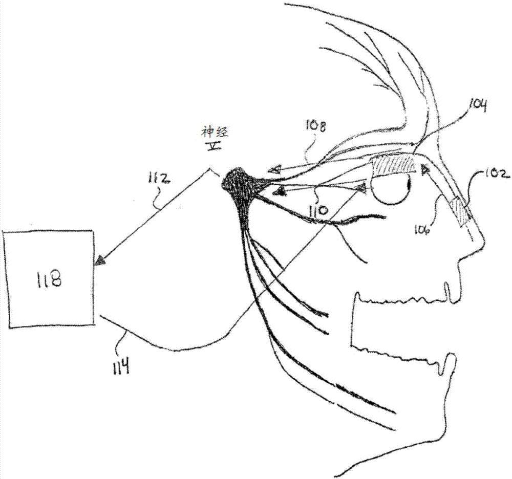 Stimulation devices and methods for treating dry eye