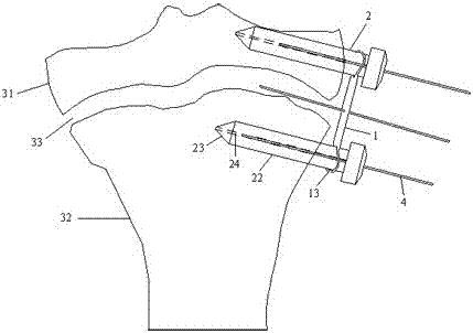 A cable type internal fixation device for orthopedics